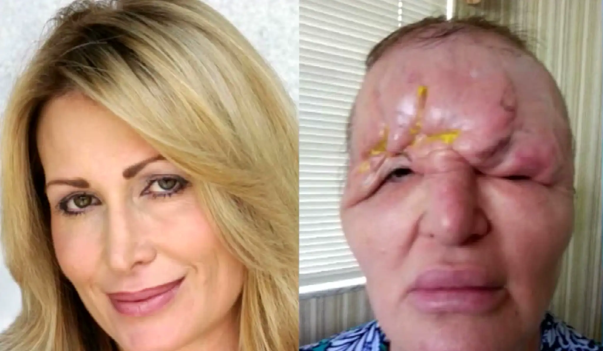 Takto Carol zmenila spackaná operácia.