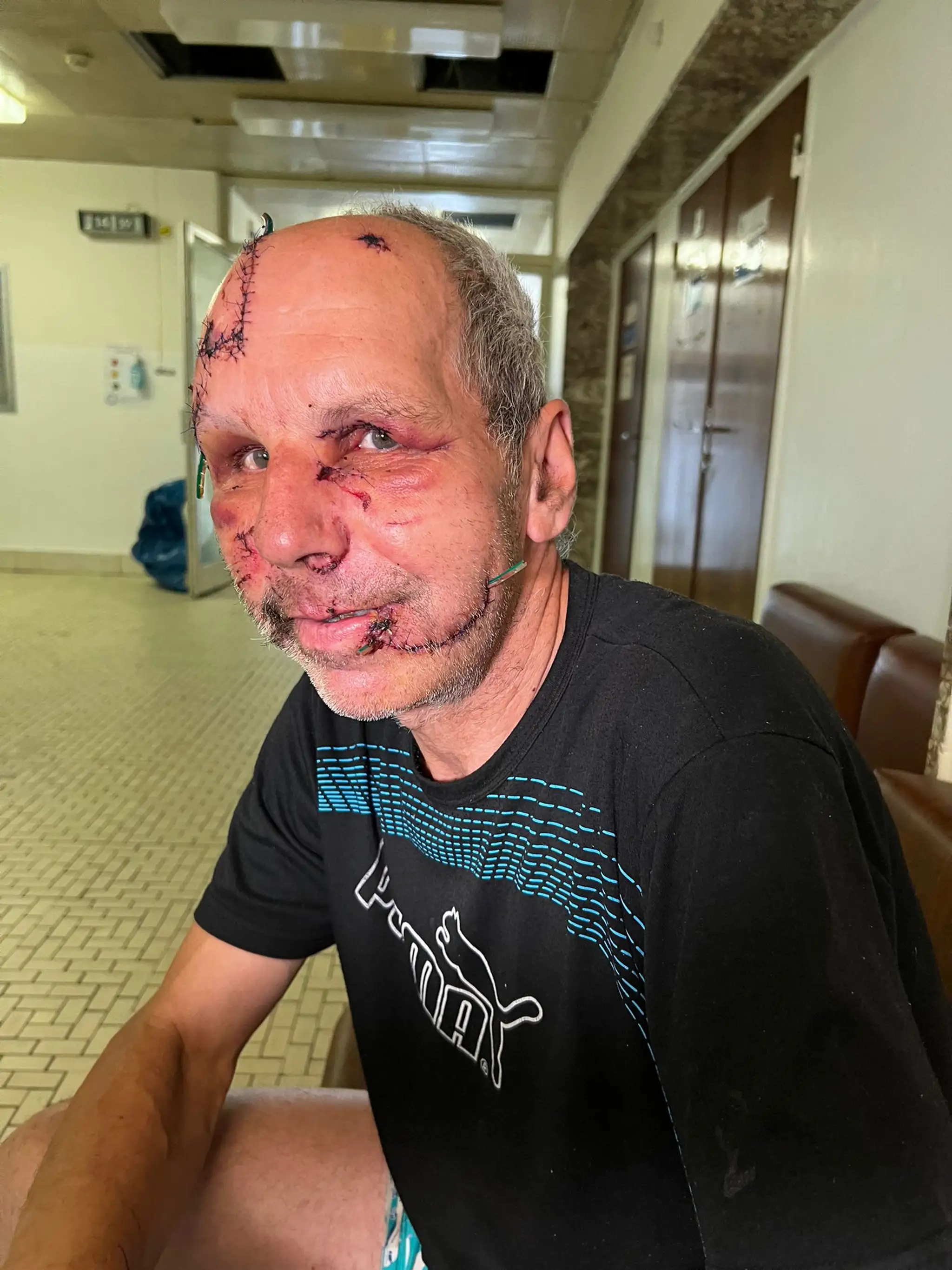 Napadnutý muž utrpel zranenia v oblasti hlavy a tváre