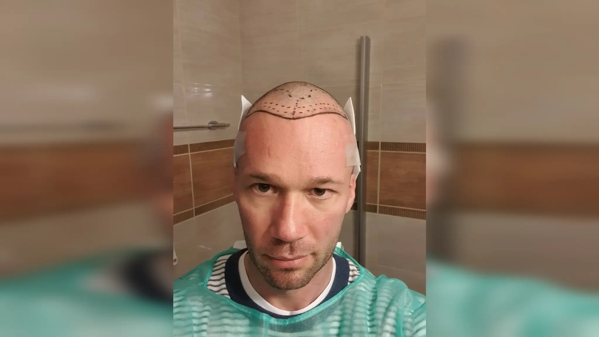 Tesne pred zákrokom.