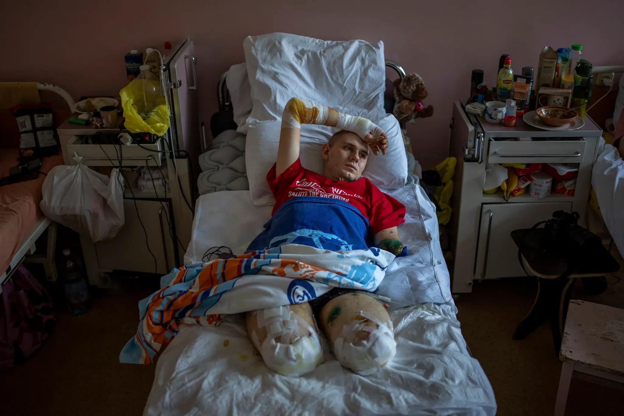Ukrajinský zdravotník Anton Gladun, ktorý prišiel v bojoch o obidve nohy, leží na lôžku v nemocnici v meste Čerkasy.
