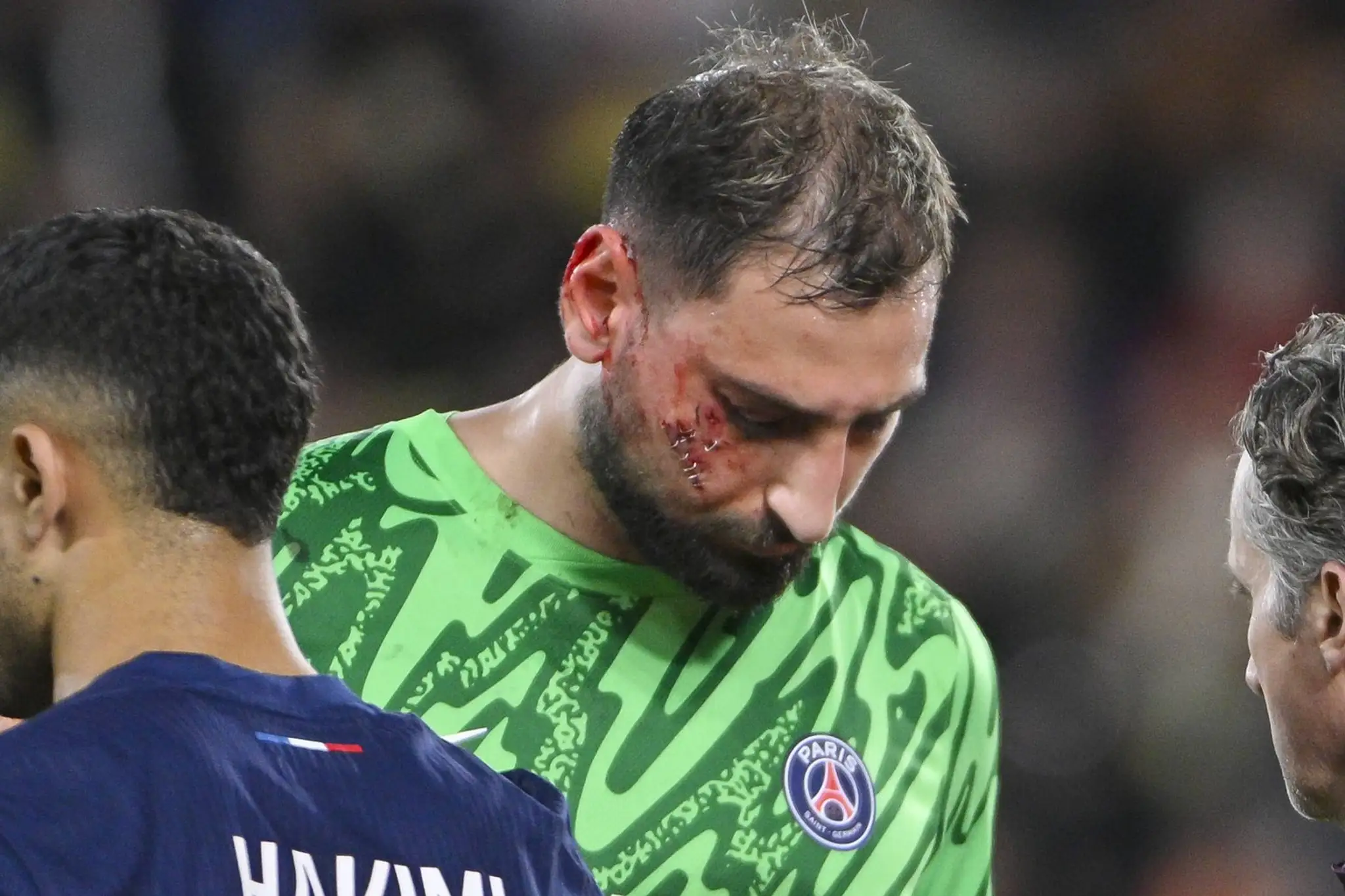 Gianluigi Donnarumma utrpel krvavé zranenie tváre.