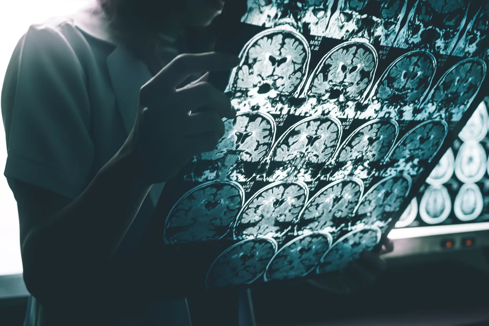 Alzheimerova choroba