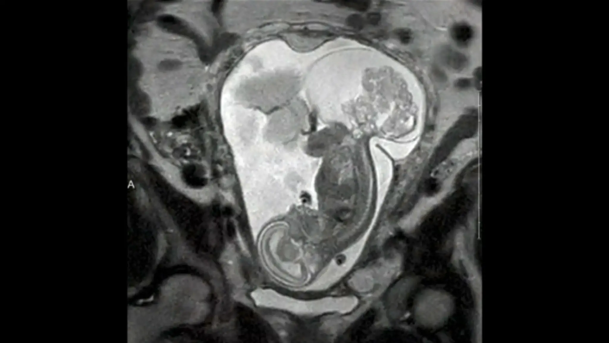 Dieťa a tumor