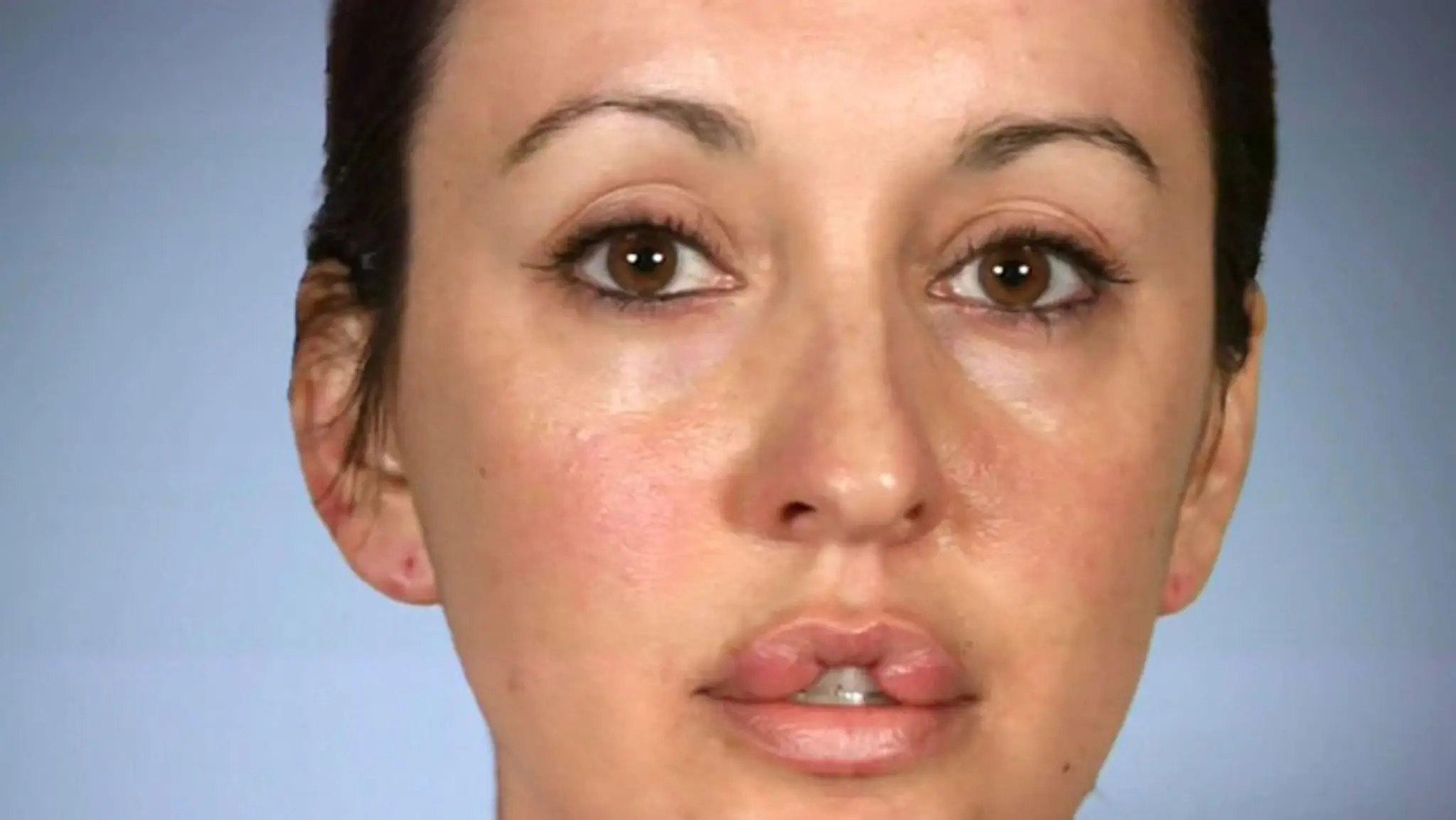 Keara chcela mať pery ako Angelina Jolie.