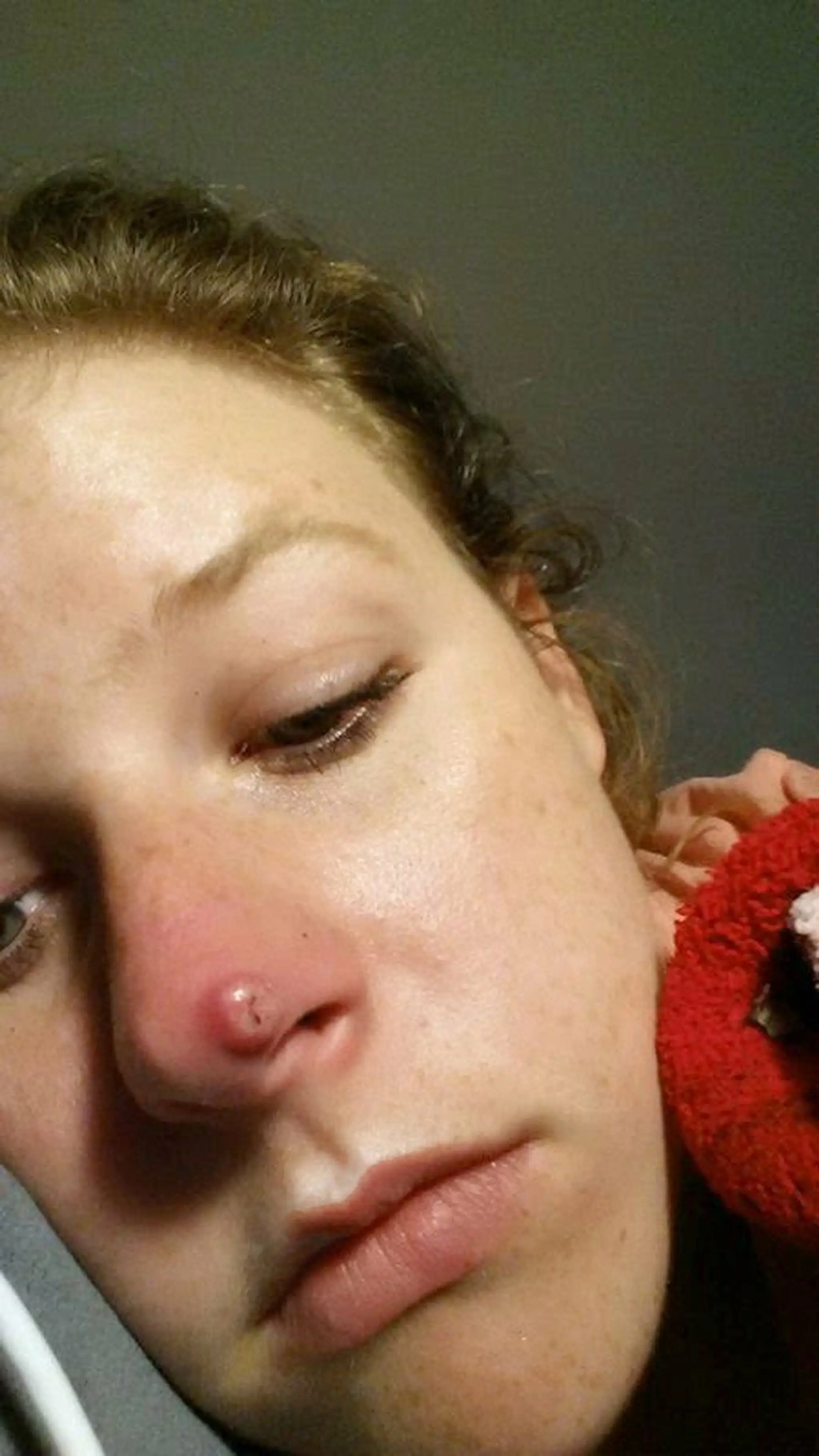 Z pupienka sa vykľula agresívna forma rakoviny