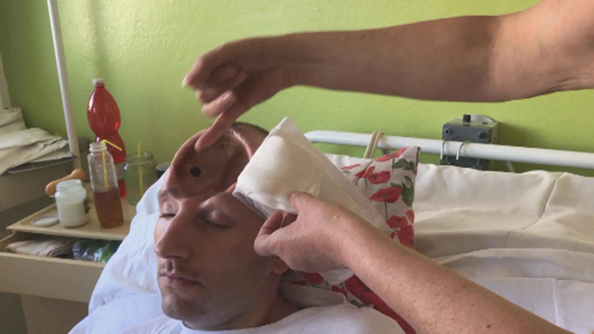 Takto vyzerá Robova lebka po pracovnom úraze a operácii.