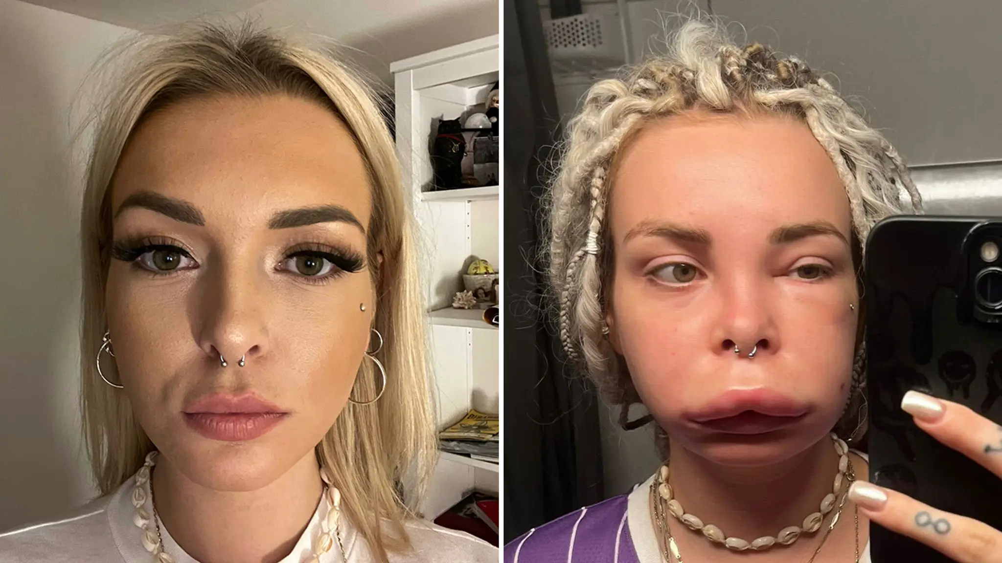 Veronika trpí vzácnym dedičným ochorením.
