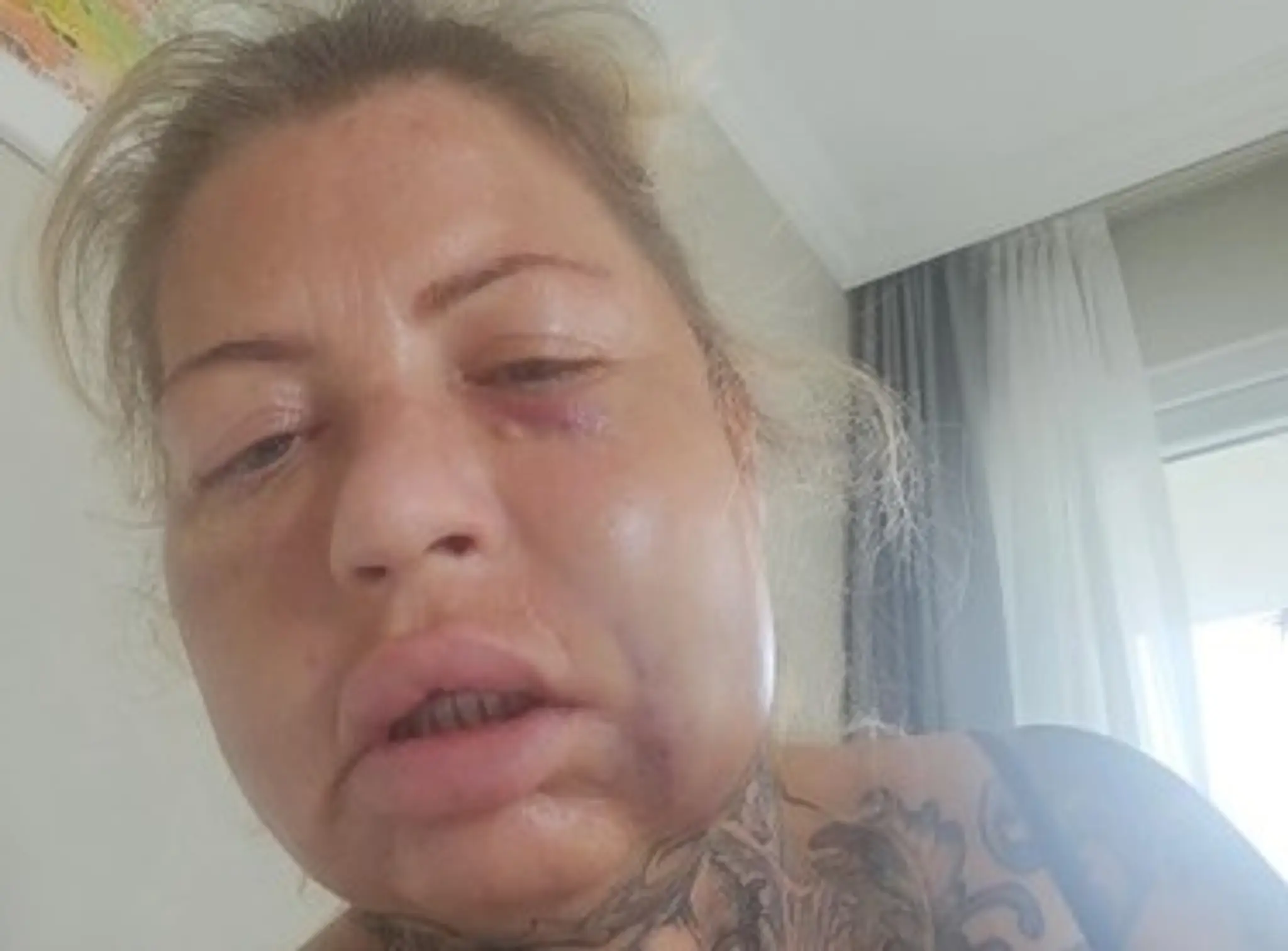 Vicky Robinsonová po zákroku v Turecku