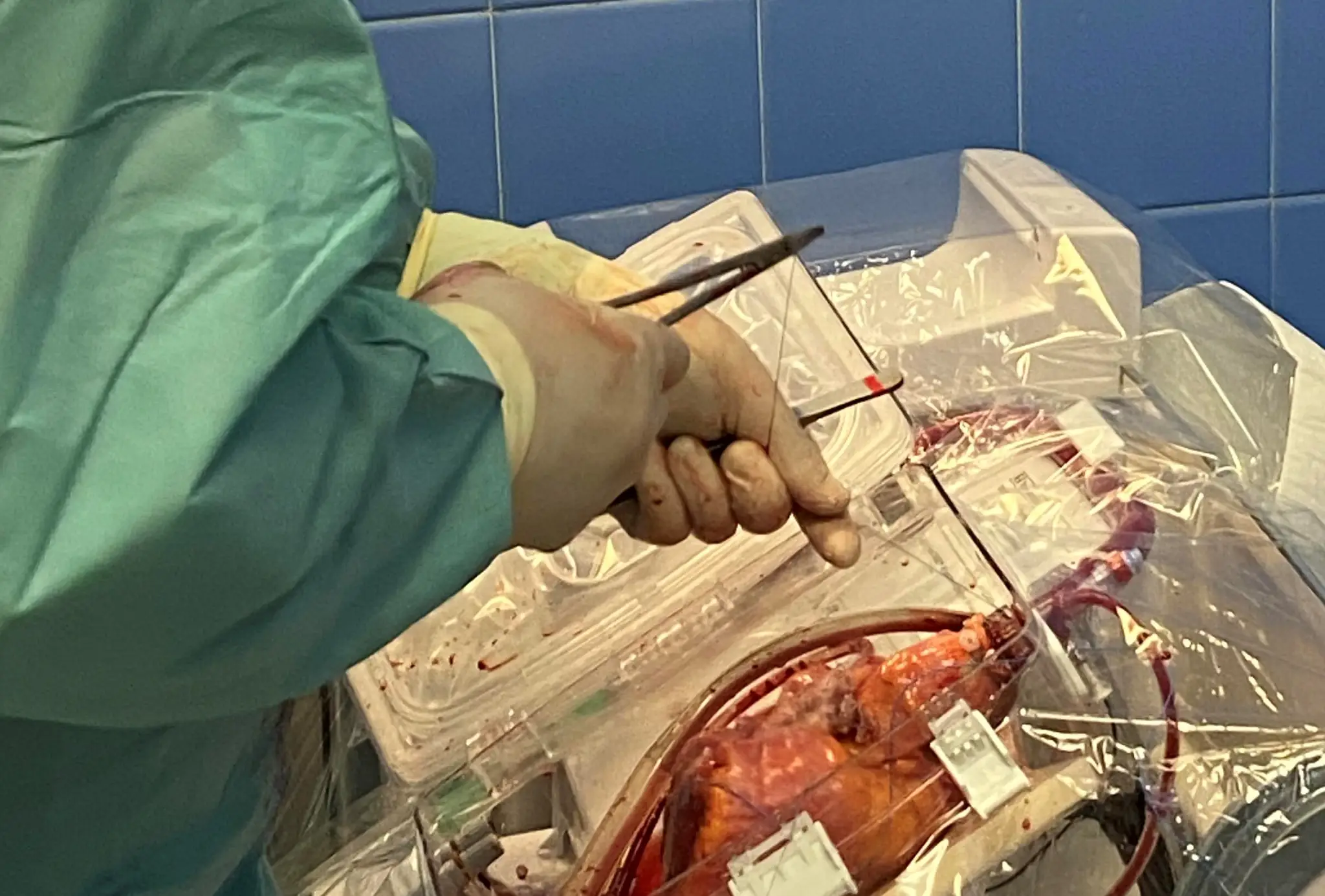 Transplantácia bijúceho srdca.