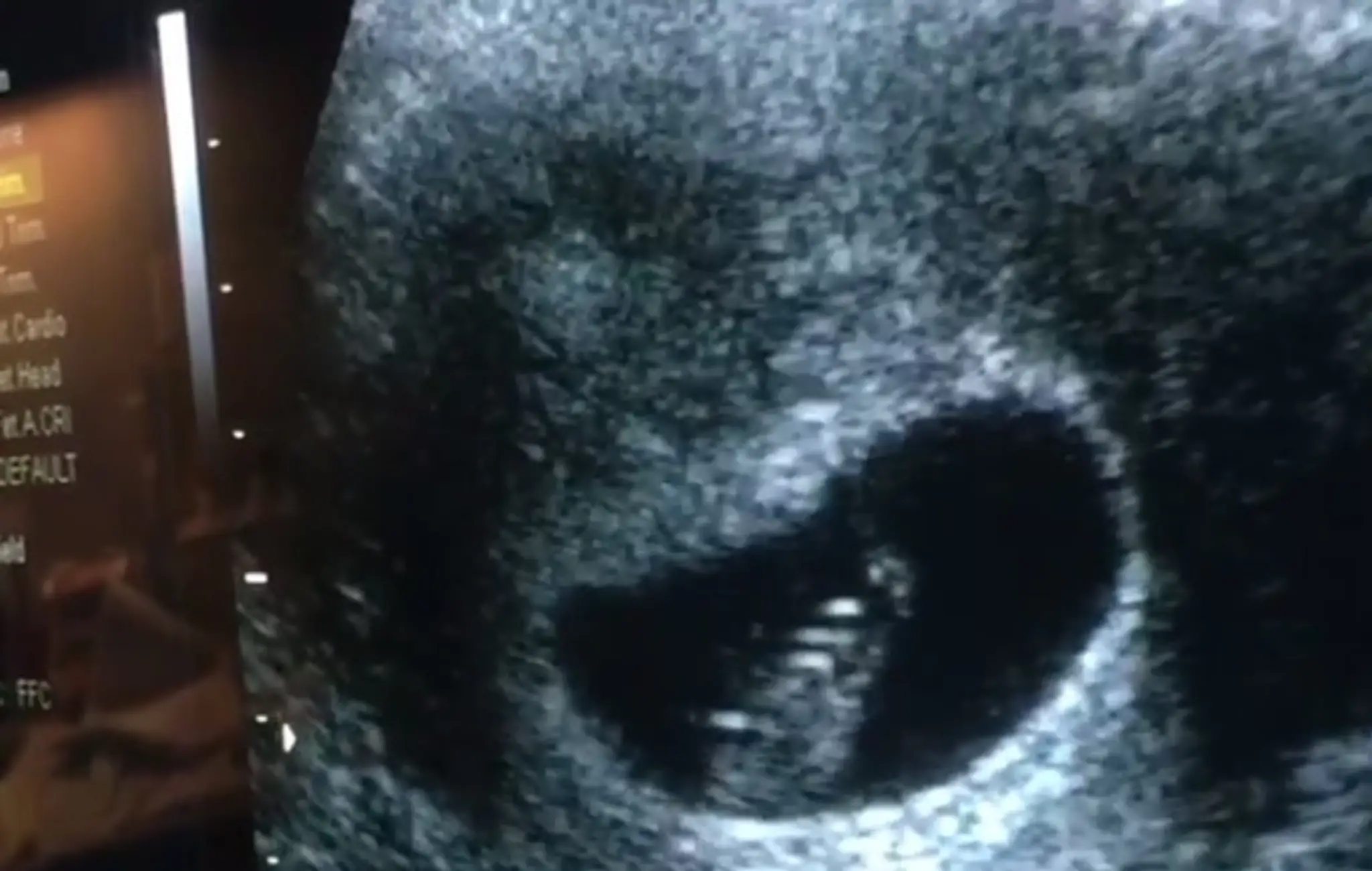 Hviezda Tudorovcov zverejnila video so zdrvujúcou správou. Srdiečko bábätka už nebilo
