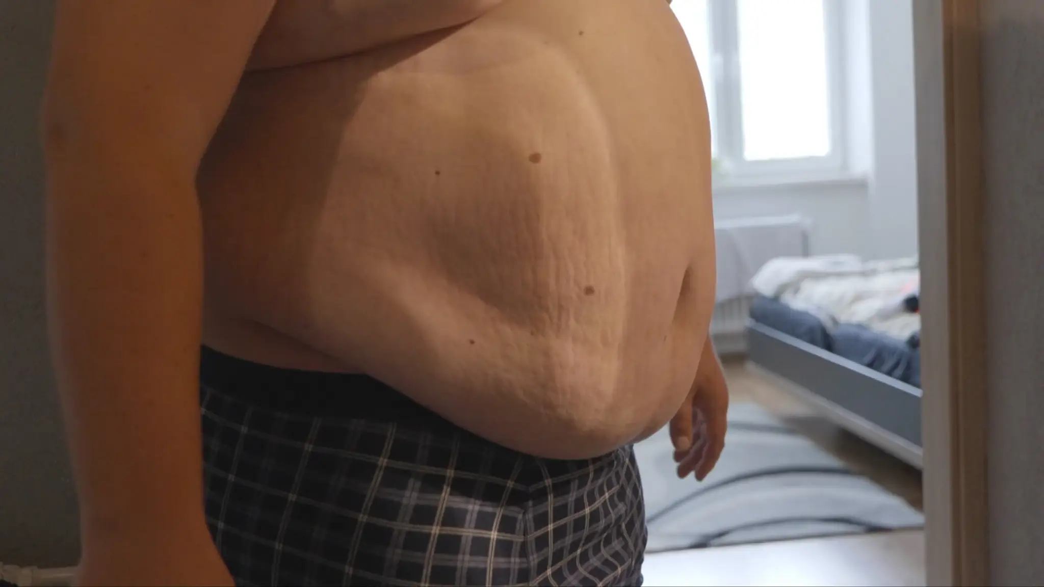 Obezita.