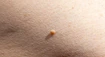 Malé kožné výrastky vyzerajú nevinne. Dermatologička varuje pred ich domácim odstraňovaním