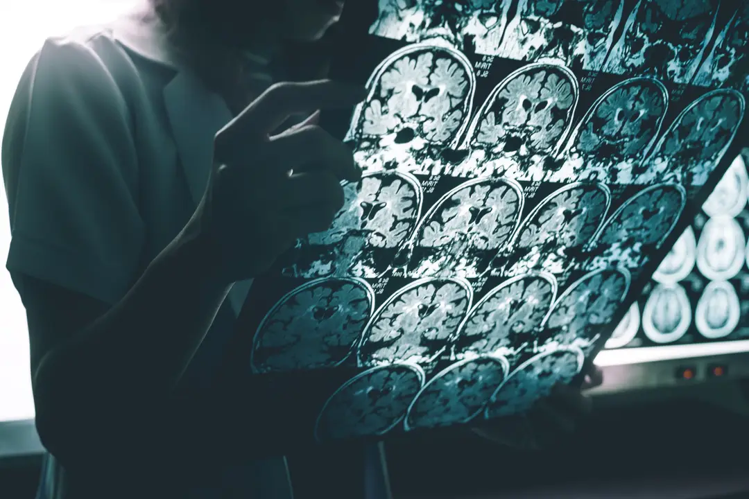 Alzheimerova choroba 