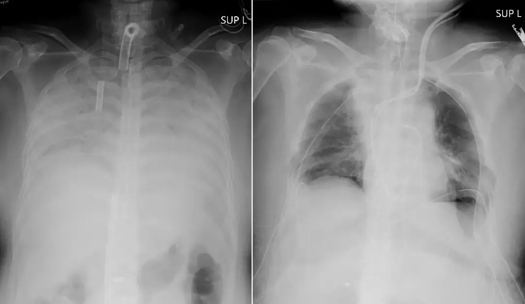 Pľúca pacientky pred transplantáciou a po nej