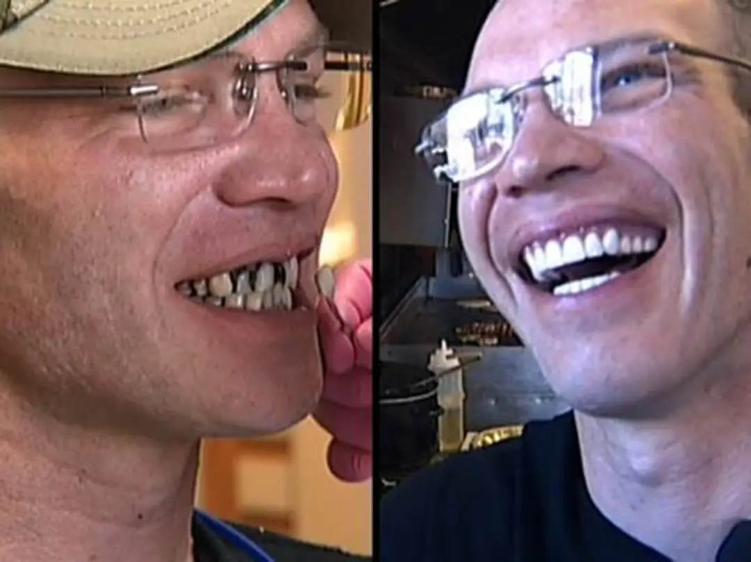 Brianov úsmev pred a po zákroku.