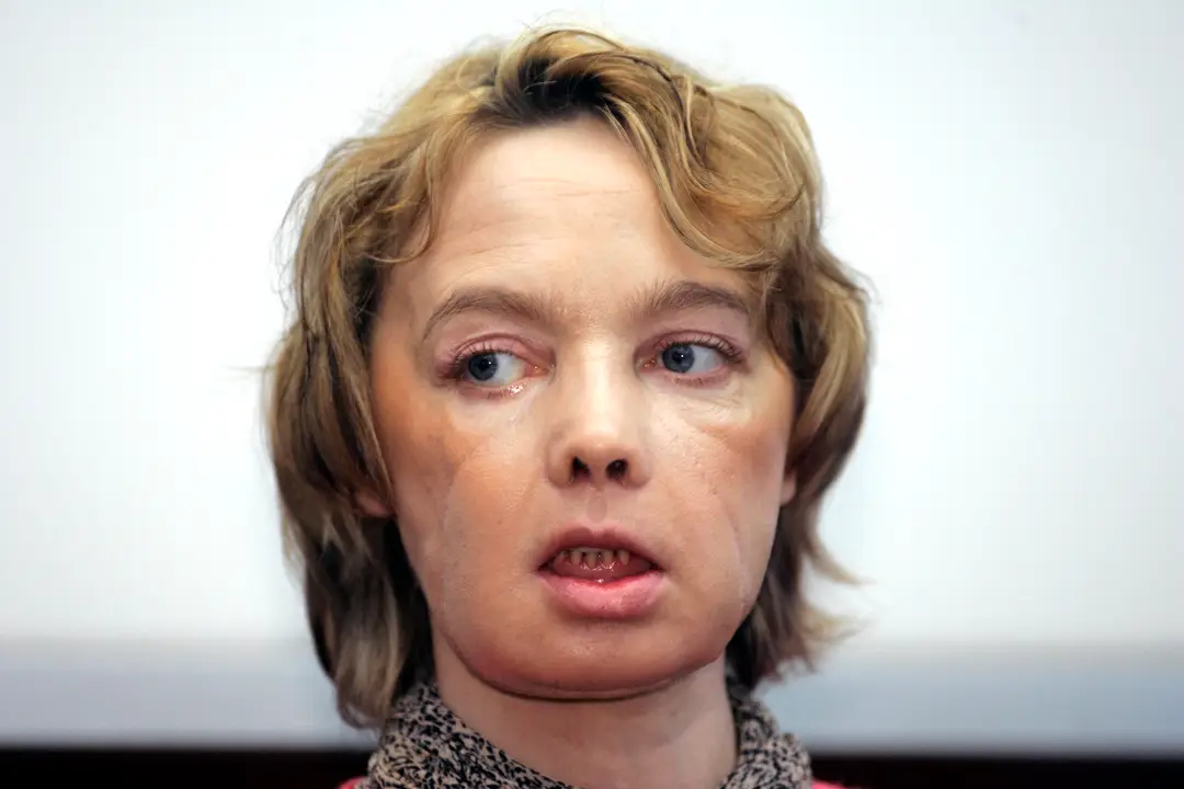 Isabelle Dinoire