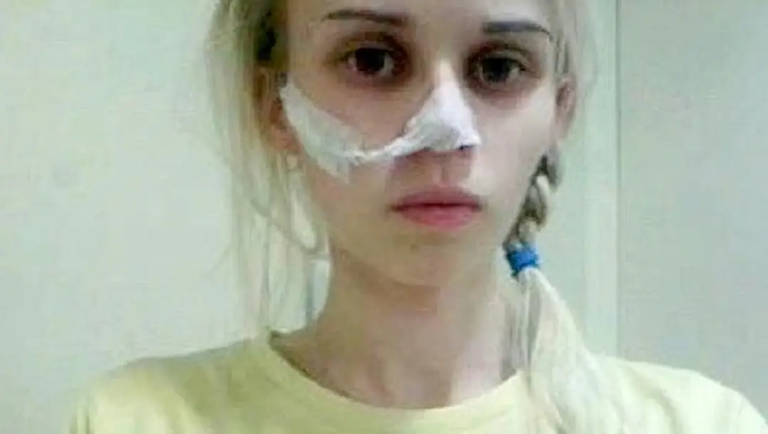 Sophie Hartwellová trpí mentálnou anorexiou.