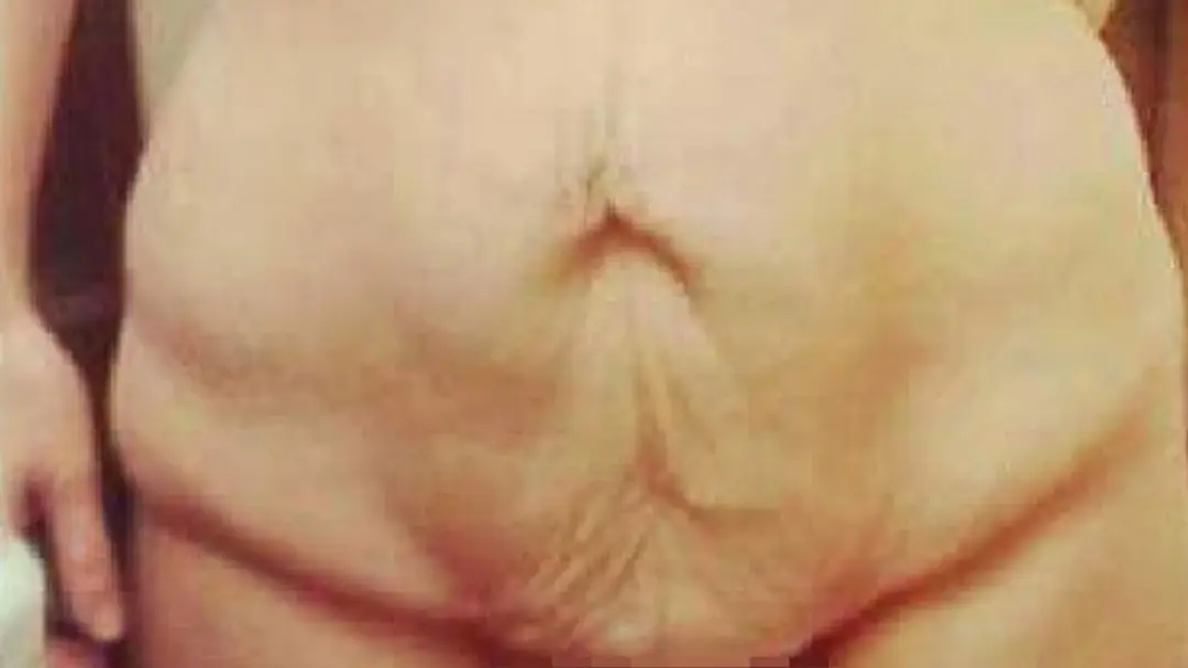 Pred operáciou. 