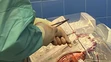 Transplantácia bijúceho srdca. 