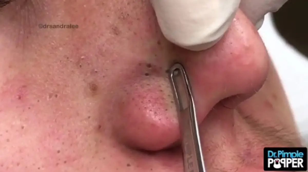 Videá vytláčania vyrážok sledujú milóny ľudí. Relaxujú pri tom
