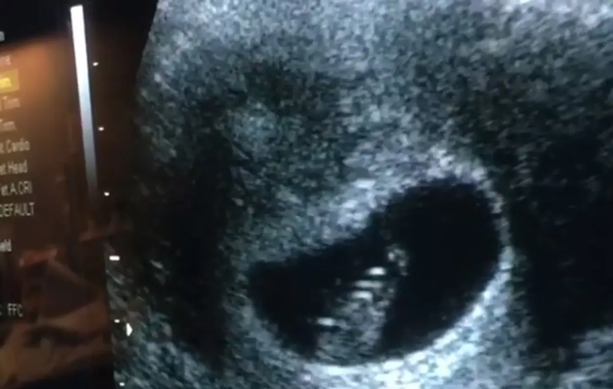 Hviezda Tudorovcov zverejnila video so zdrvujúcou správou. Srdiečko bábätka už nebilo