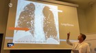 Nórskej princeznej transplantovali pľúca