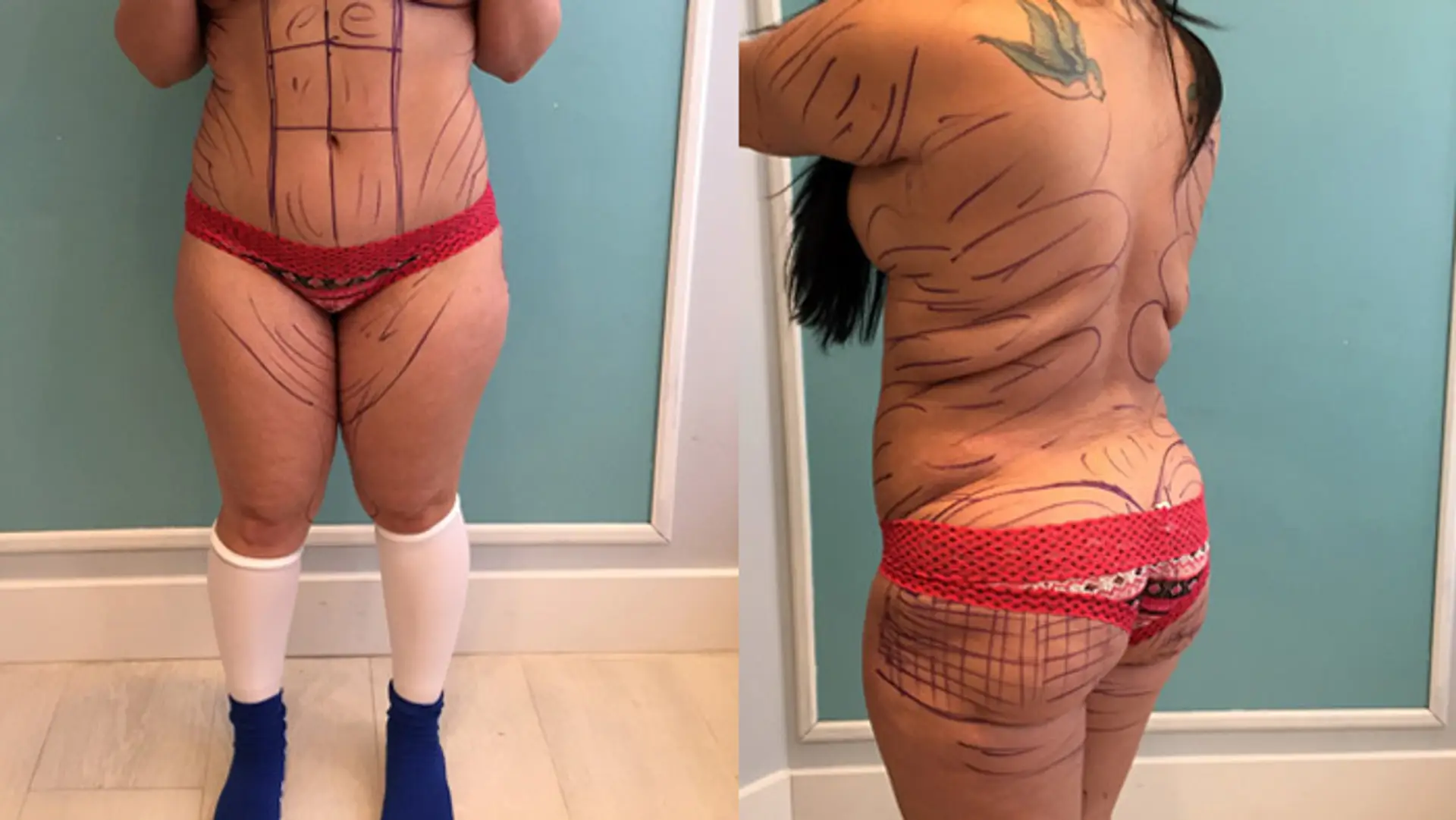 liposukcia.jpg