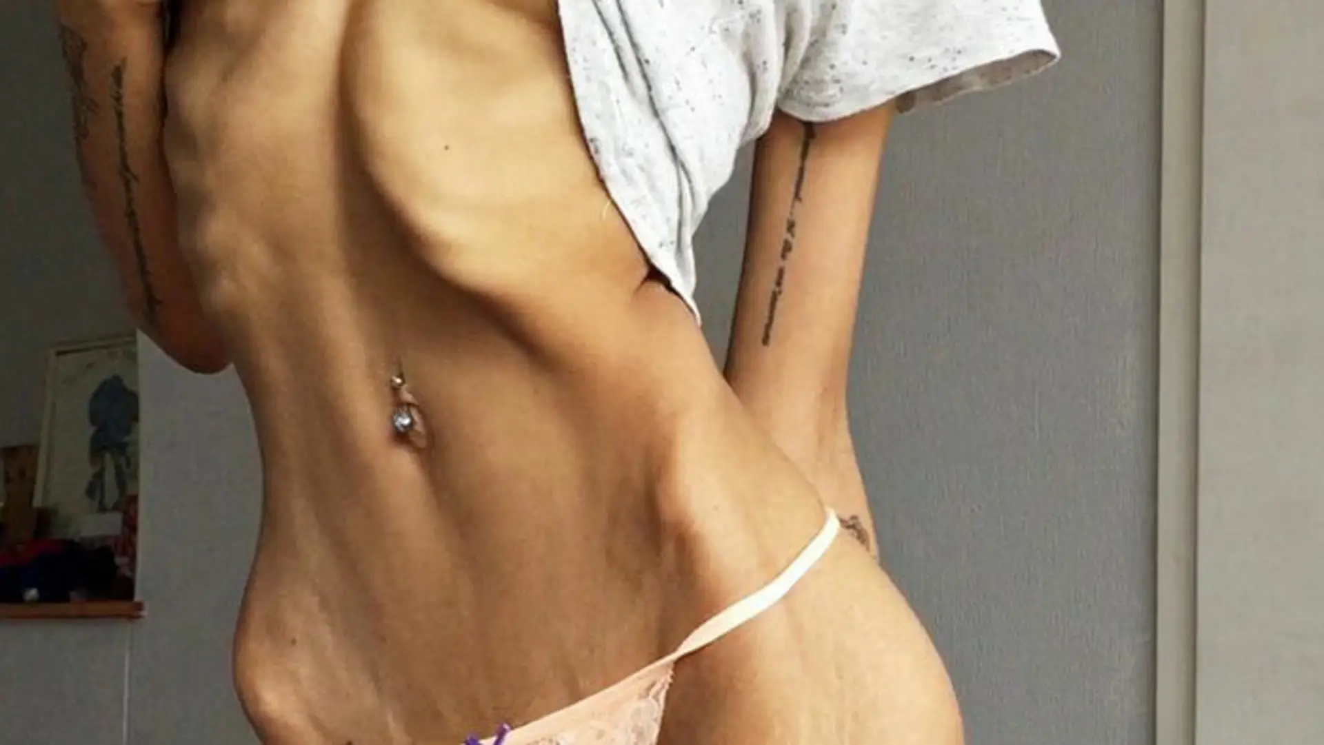 Holly Griffiths (25) vyhrala boj s anorexiou