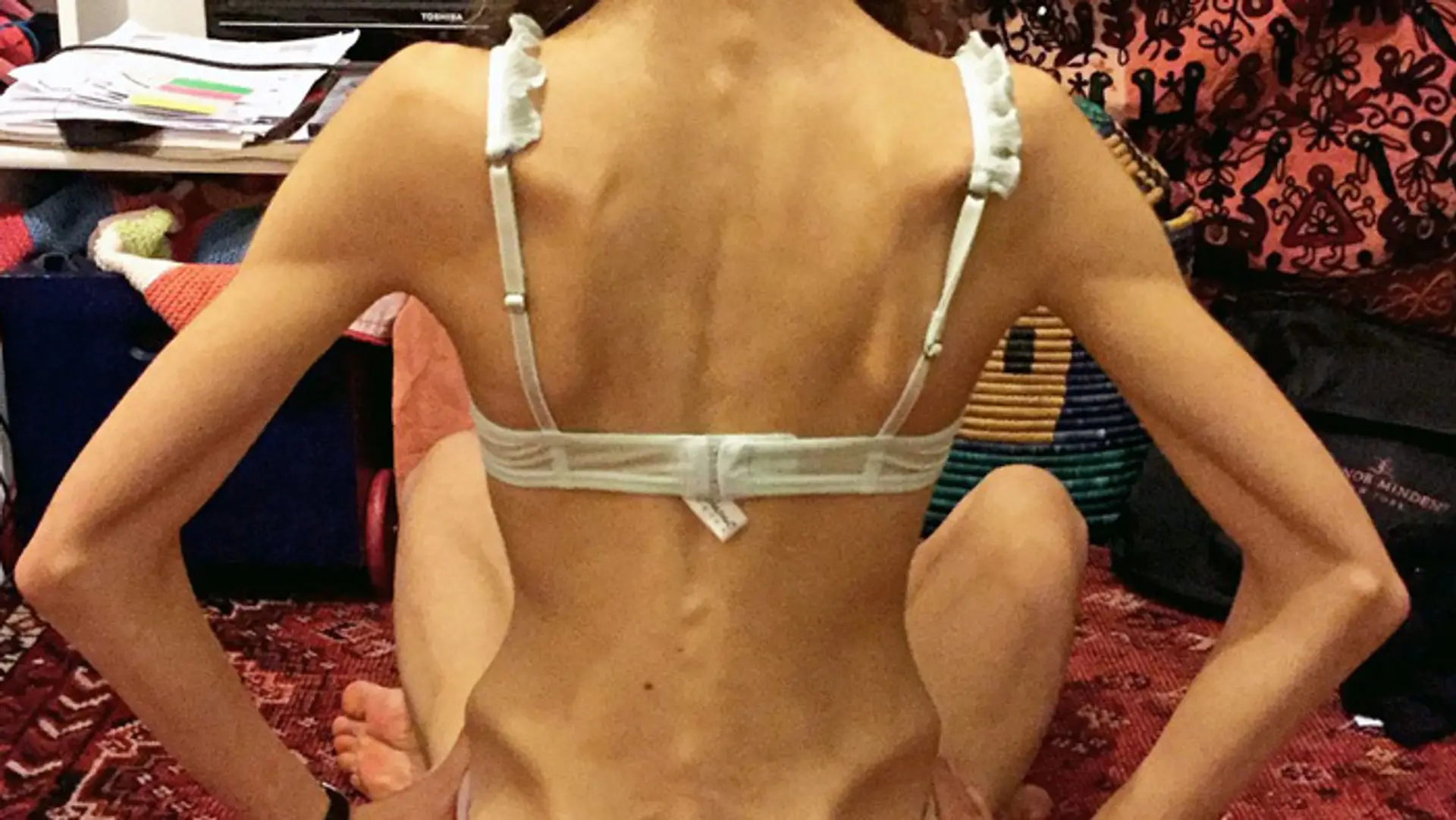 Margherita Barbieri bojovala s anorexiou.