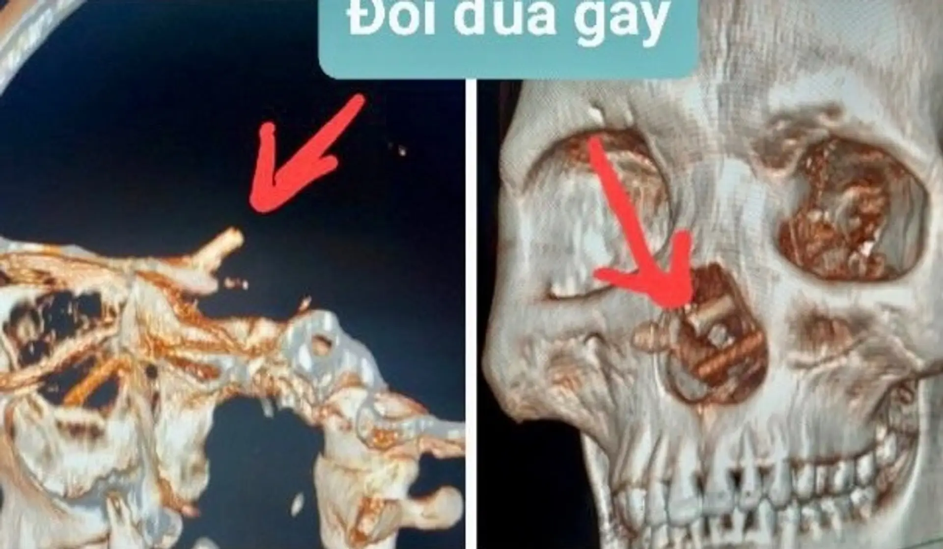 Snímka z počítačového tomografu.