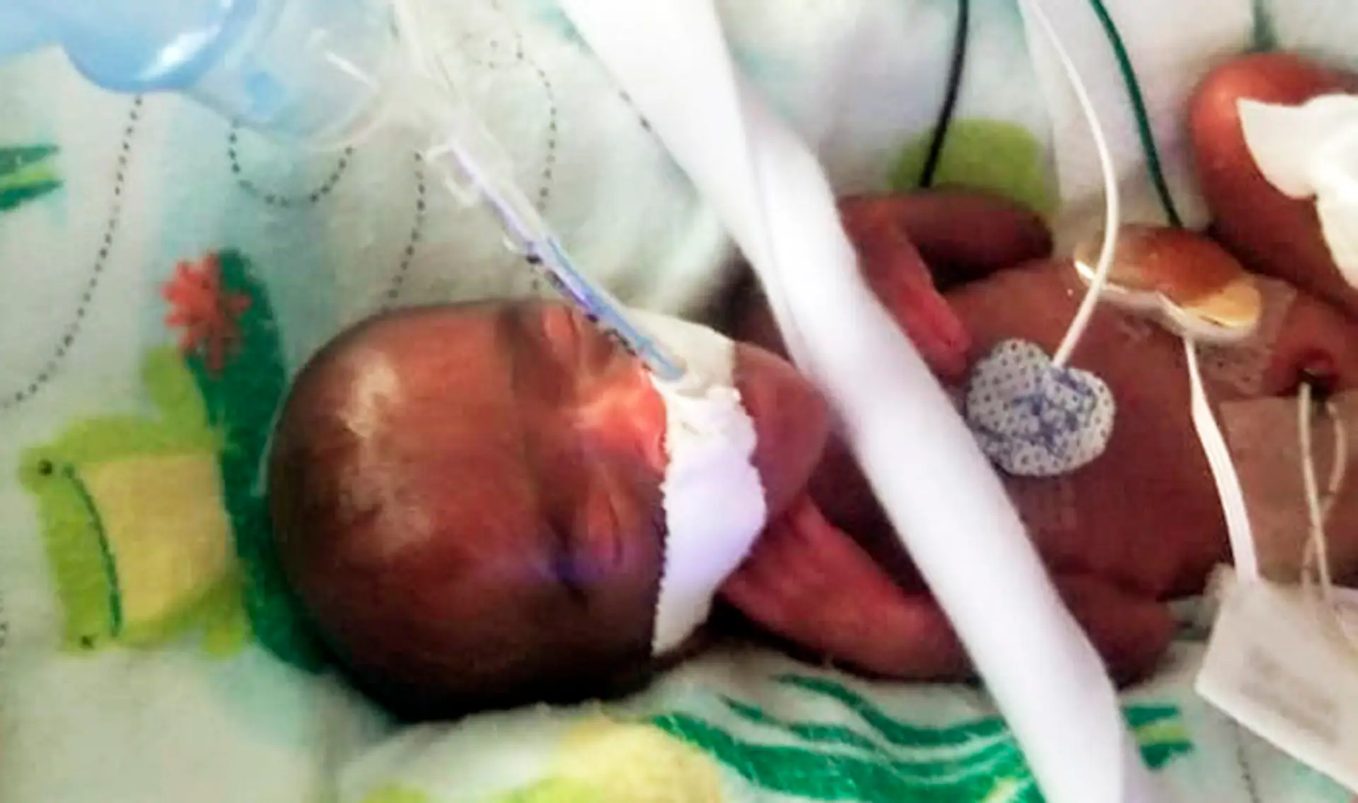 Najmenšie porodené dieťa na svete prežilo. Lekári mu dávali po pôrode hodinu