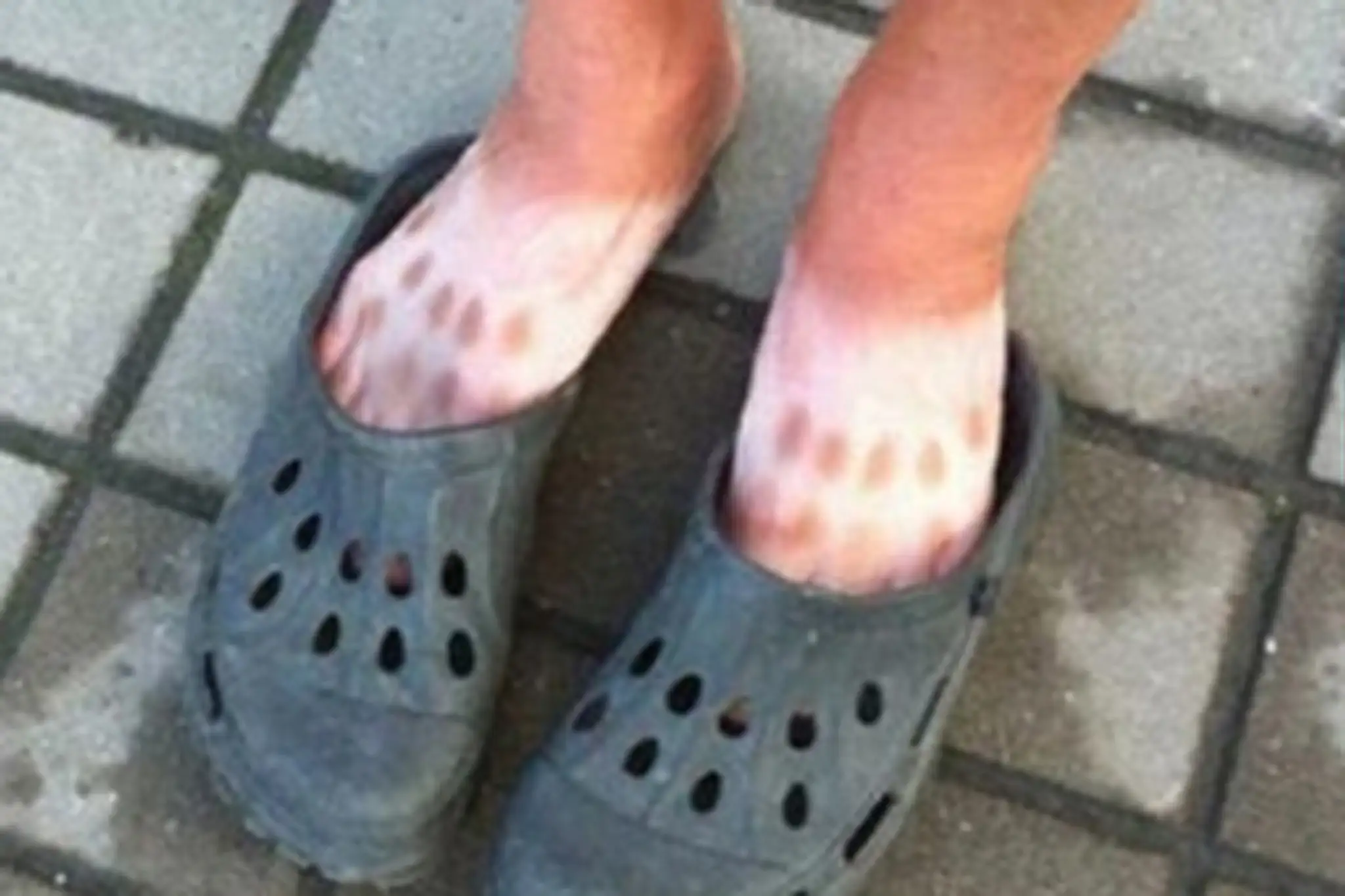 Keď chýba opaľovací krém