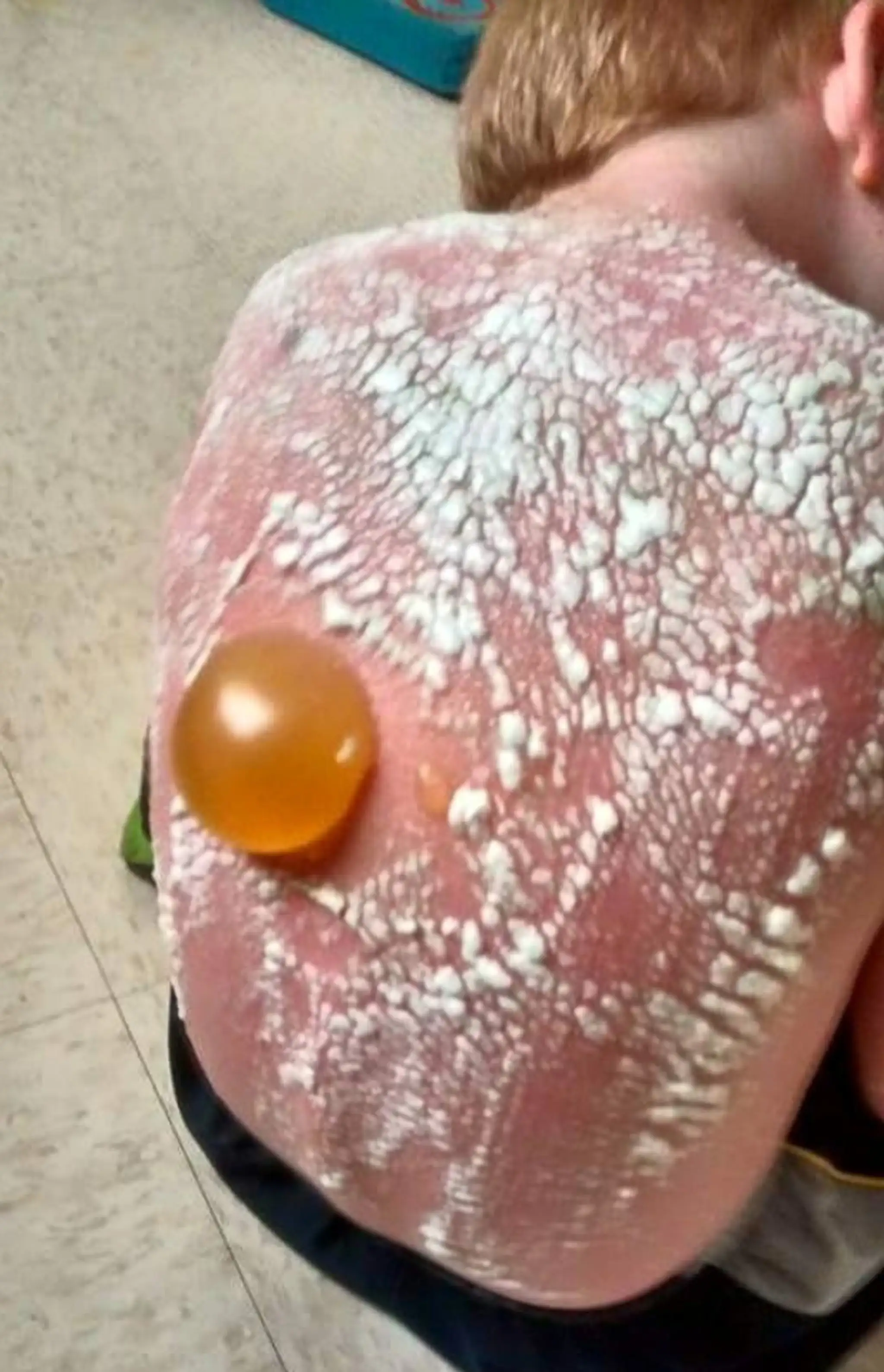 Chlapci utrpeli popáleniny druhého a tretieho stupňa.