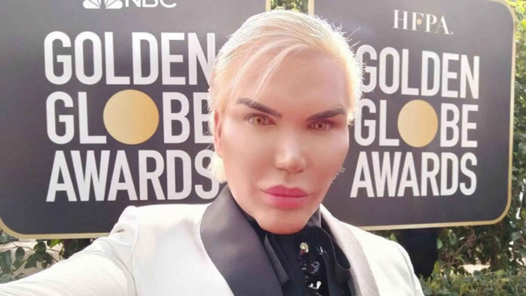 Rodrigo Alves si odfotil vyoperované rebrá