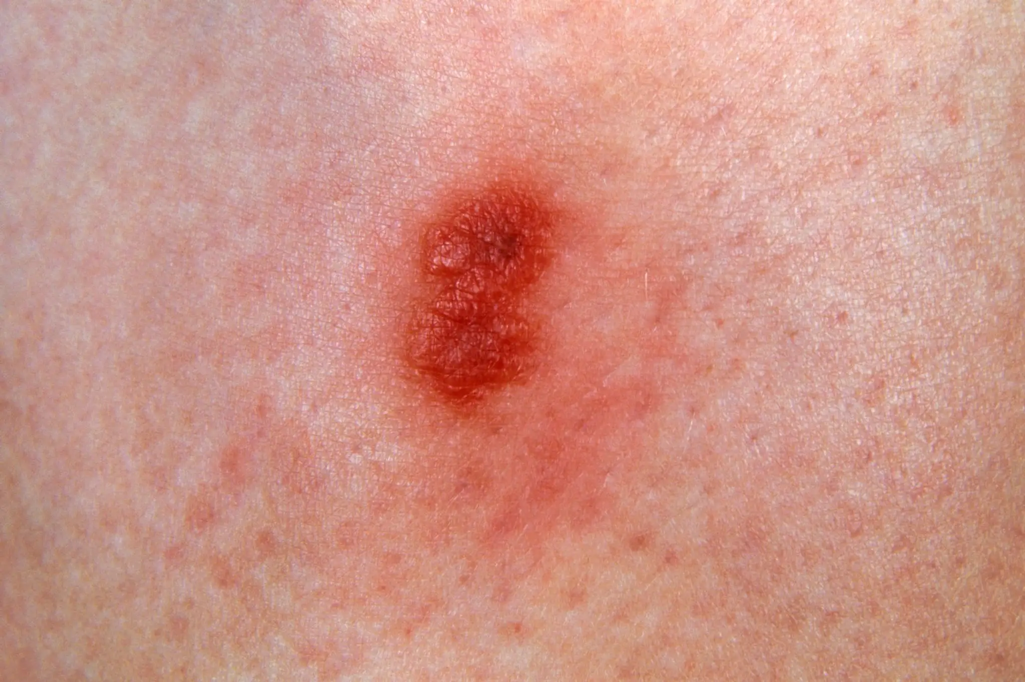 Zapálená rana po uhryznutí červeného mravca ohnivého  (Solenopsis invicta).