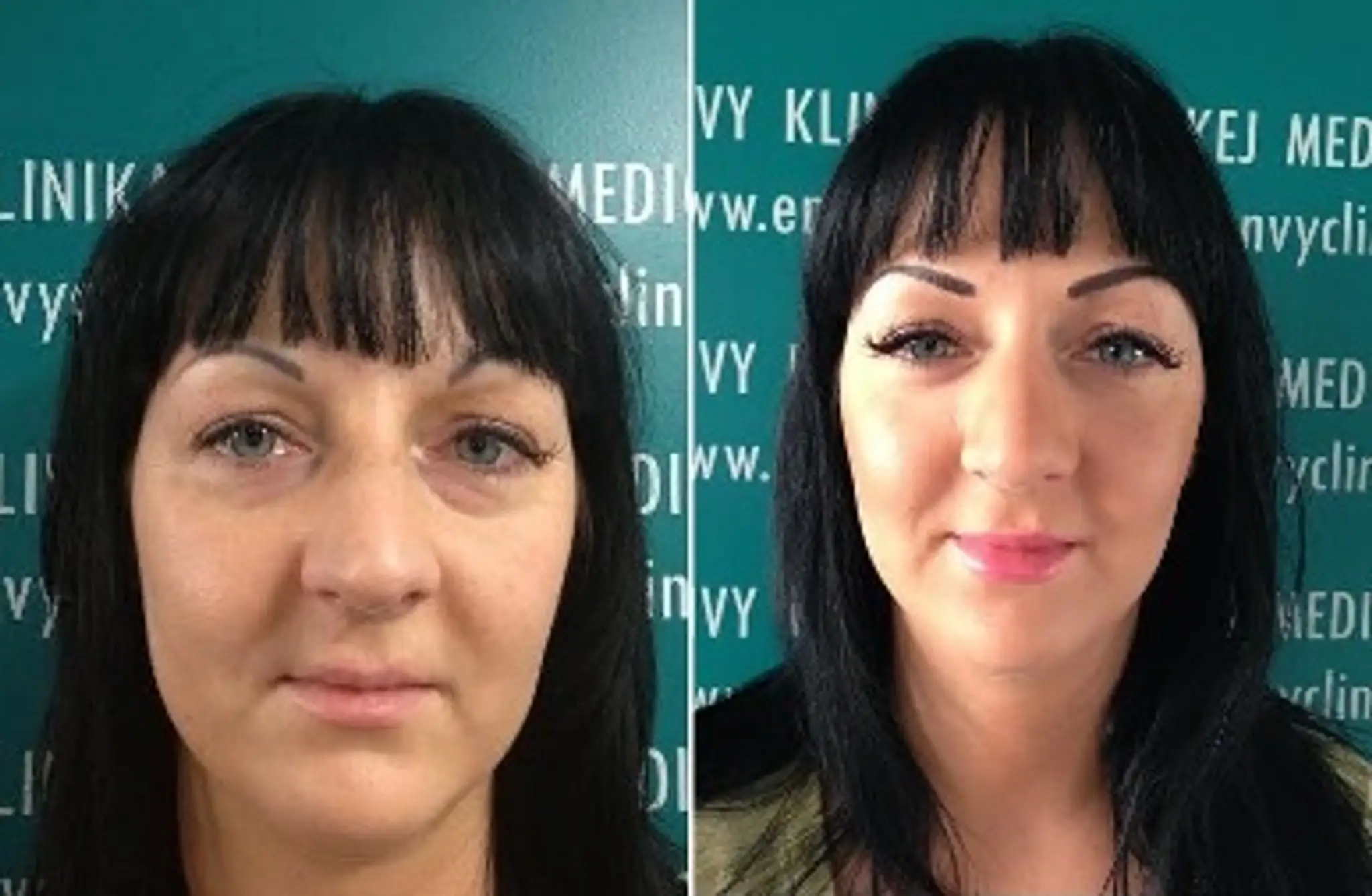 2_poradňa_Odstránenie kruhov pod očami - Klientka pred a po zákroku.jpg