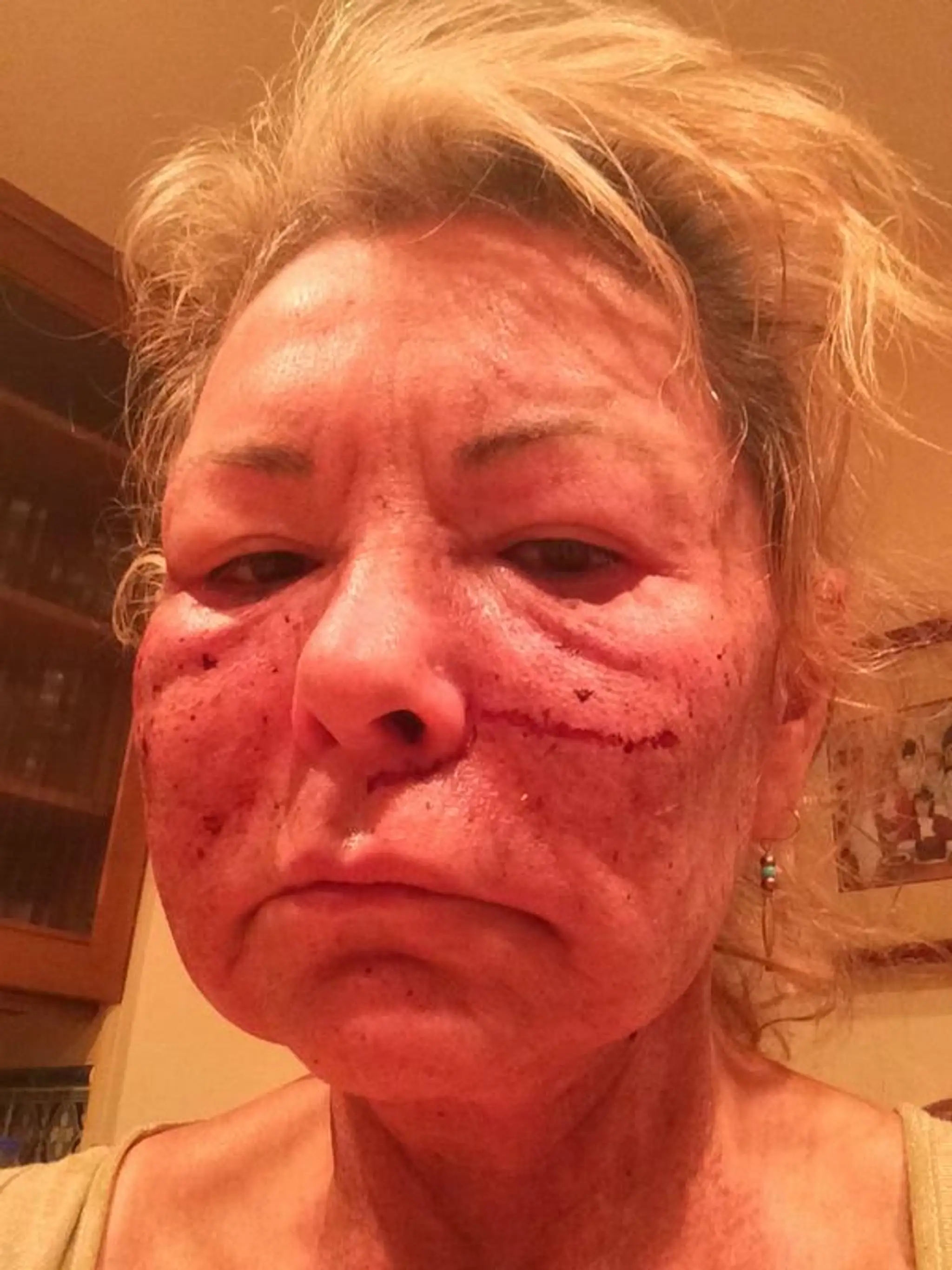 Roseanne Barr po plastike.