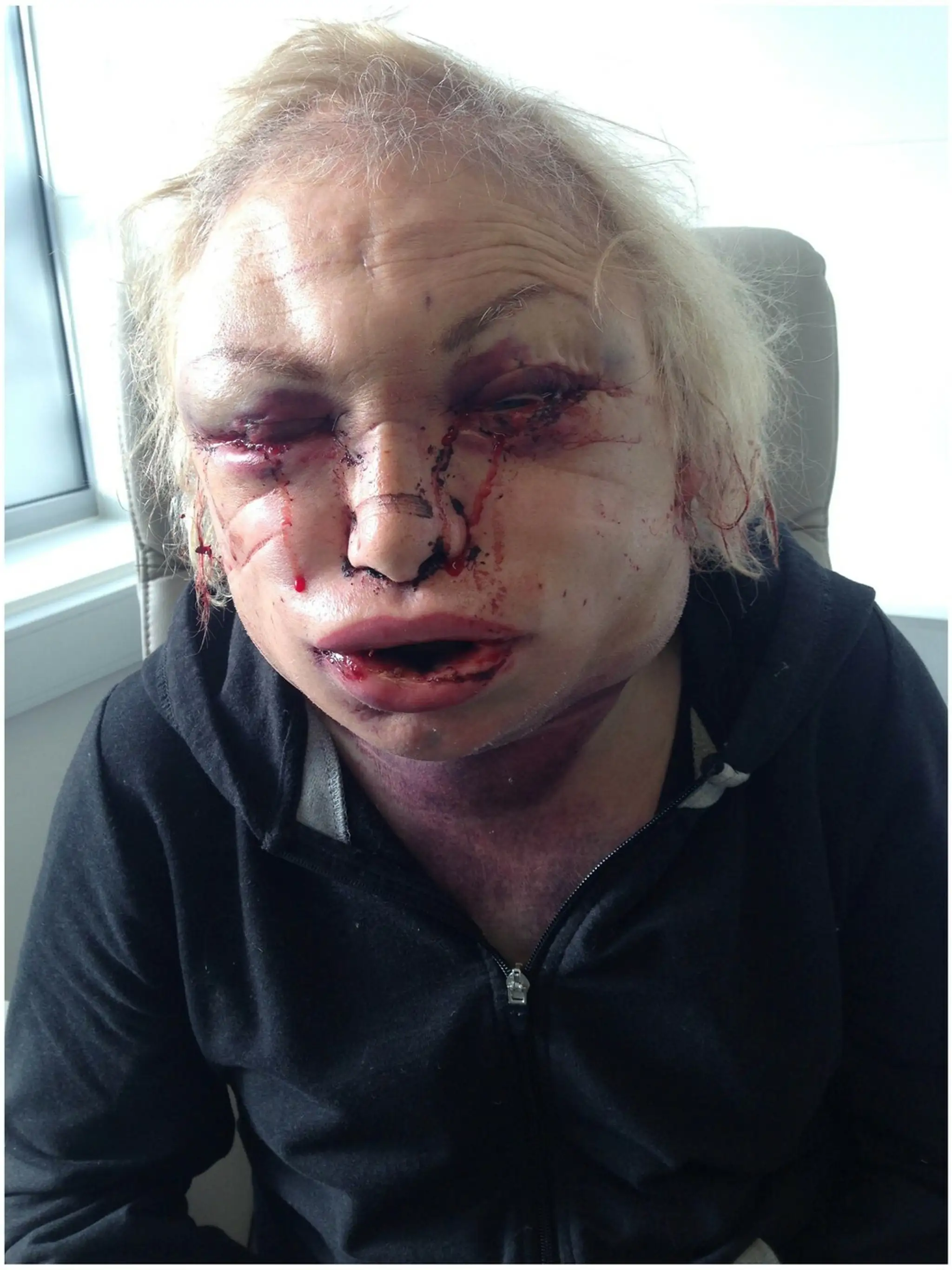 Kellie Maloney po zlej reakcii na plastiku.