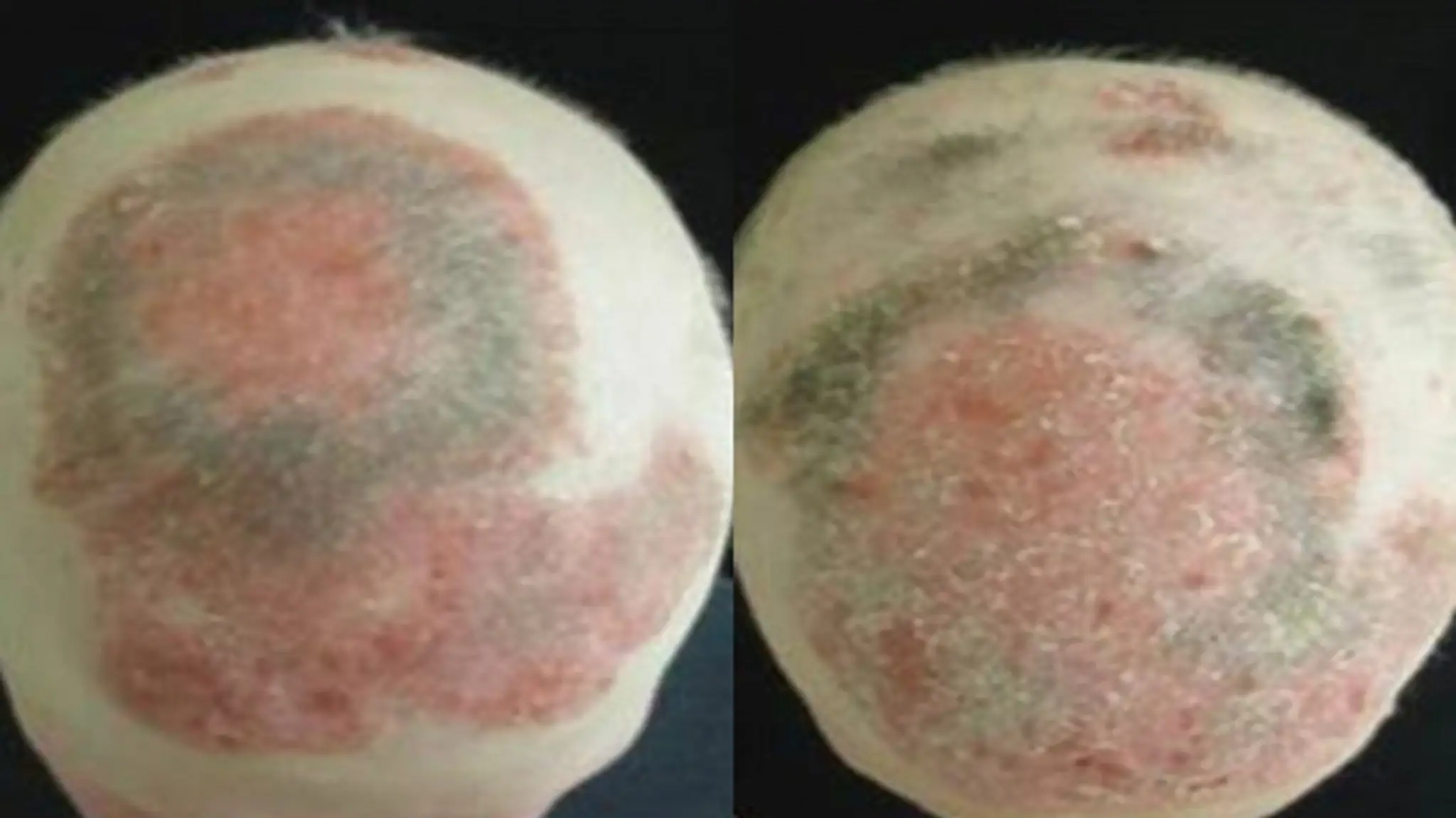 Alopecia areata