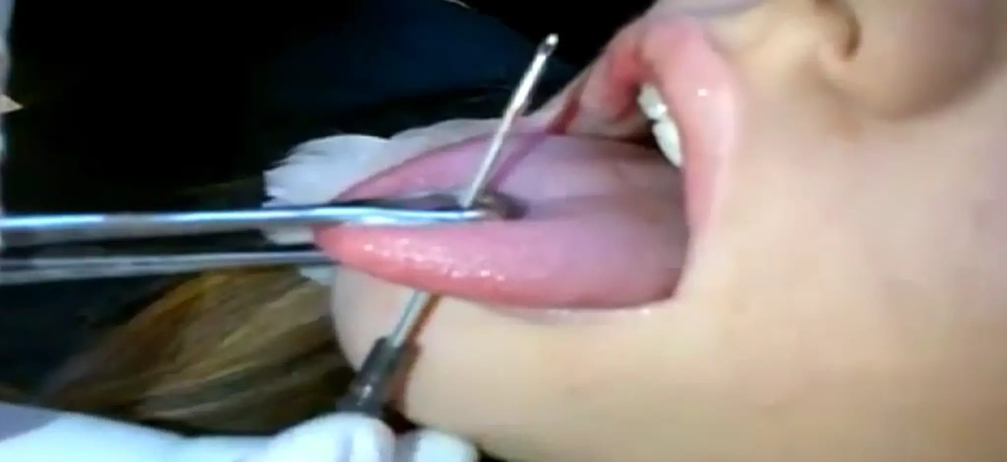 Riziká piercingu
