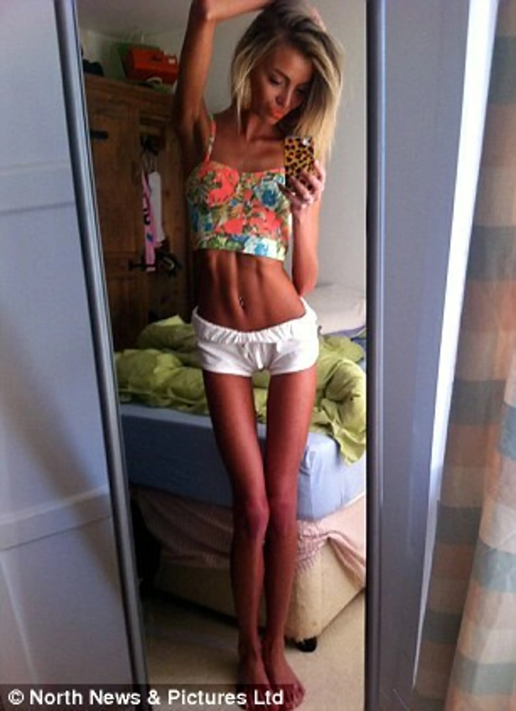 anorexia.jpg