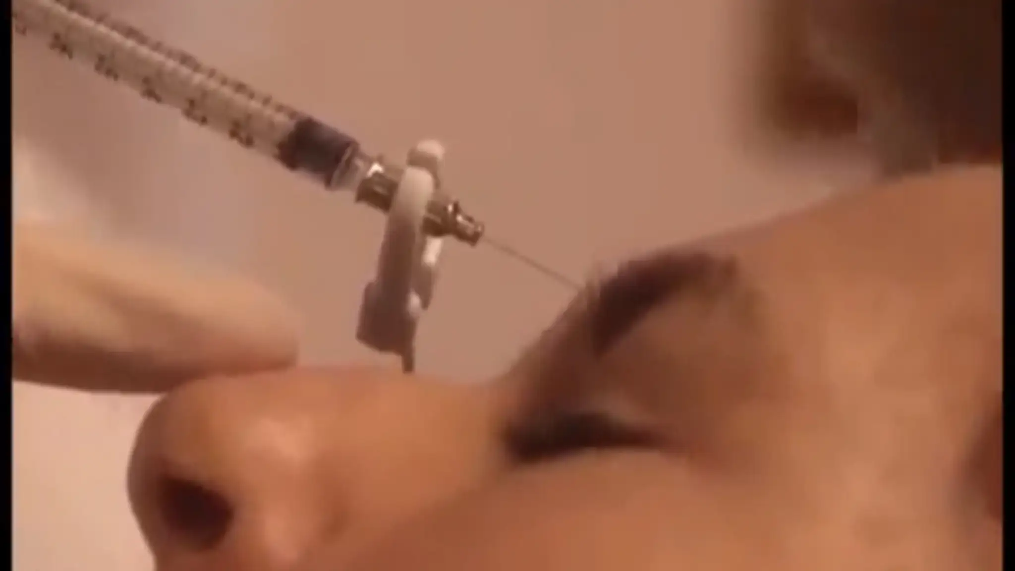 Botulotoxín využívajú v estetickej medicíne