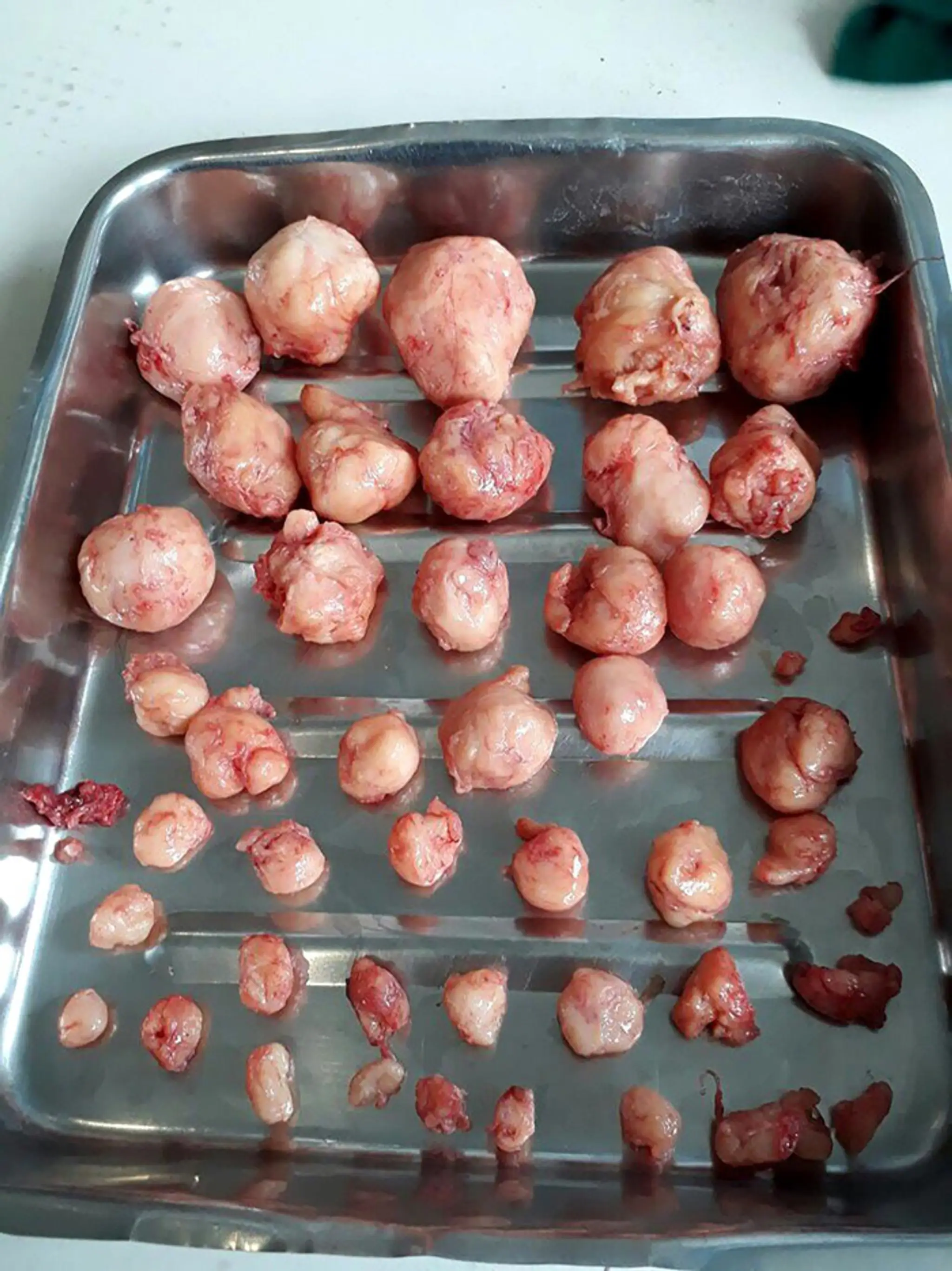 Vyoperované nezhubné tumory z tela 31-ročnej Indky.