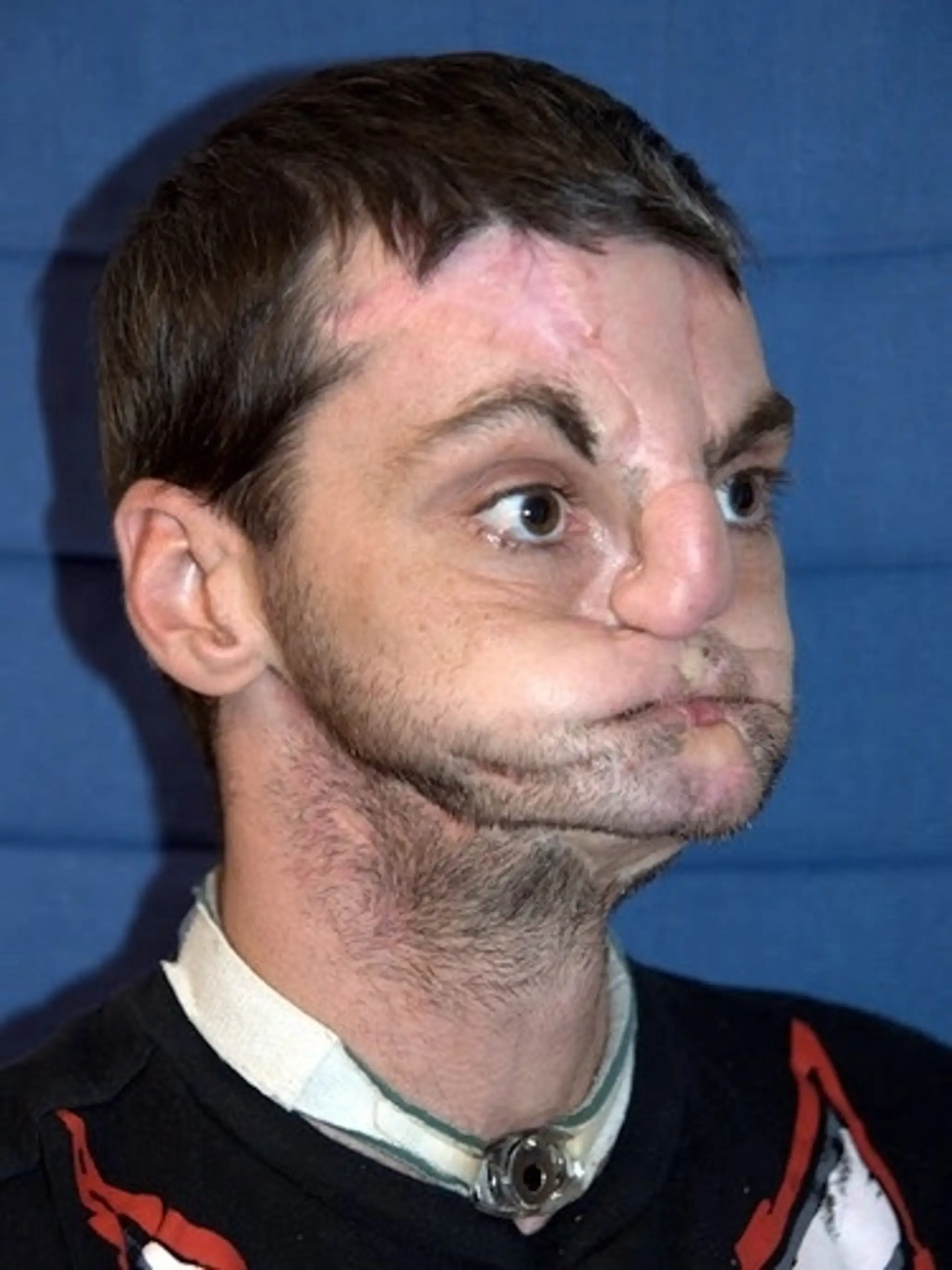 Richard Norris pred transplantáciou