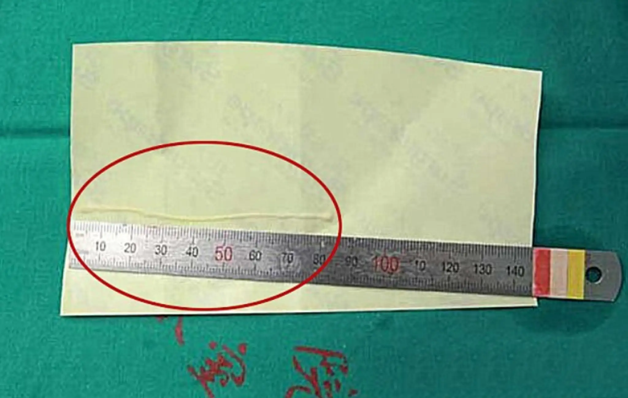 Žena mala v hlave osemcentimetrového parazita.
