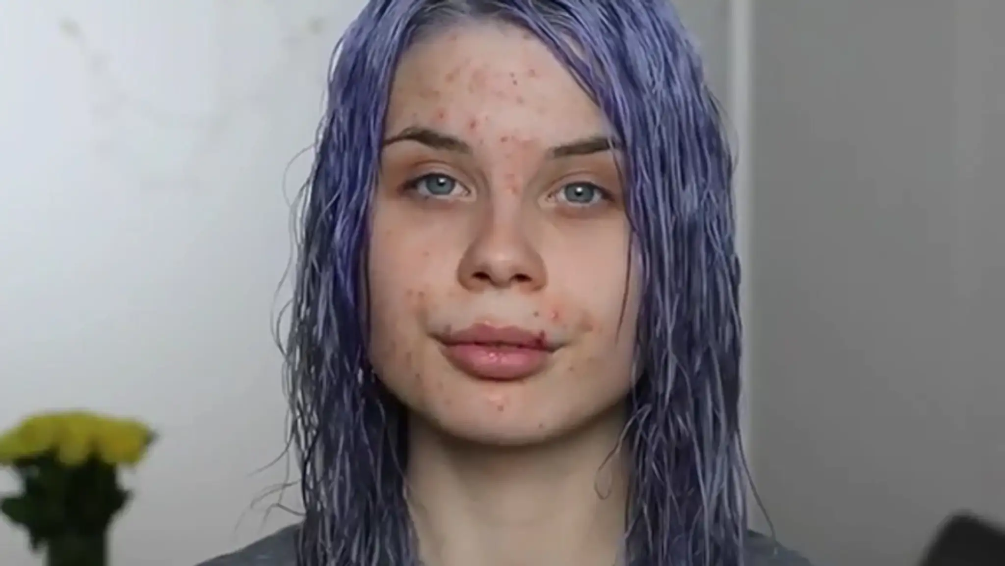 Slovenka Radka Kováčová chcela pomôcť dievčatám, ktoré majú akné.