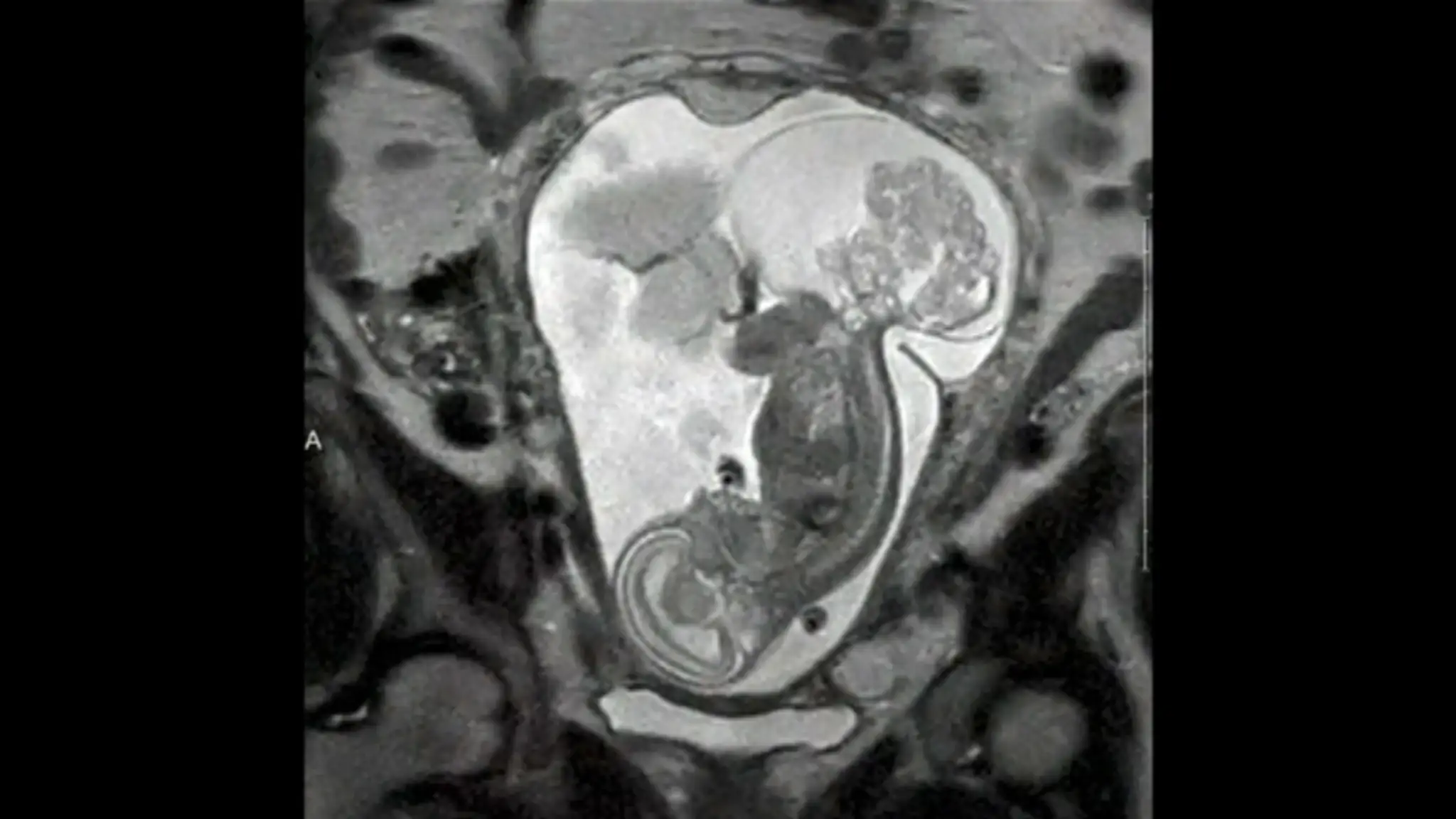 Dieťa a tumor