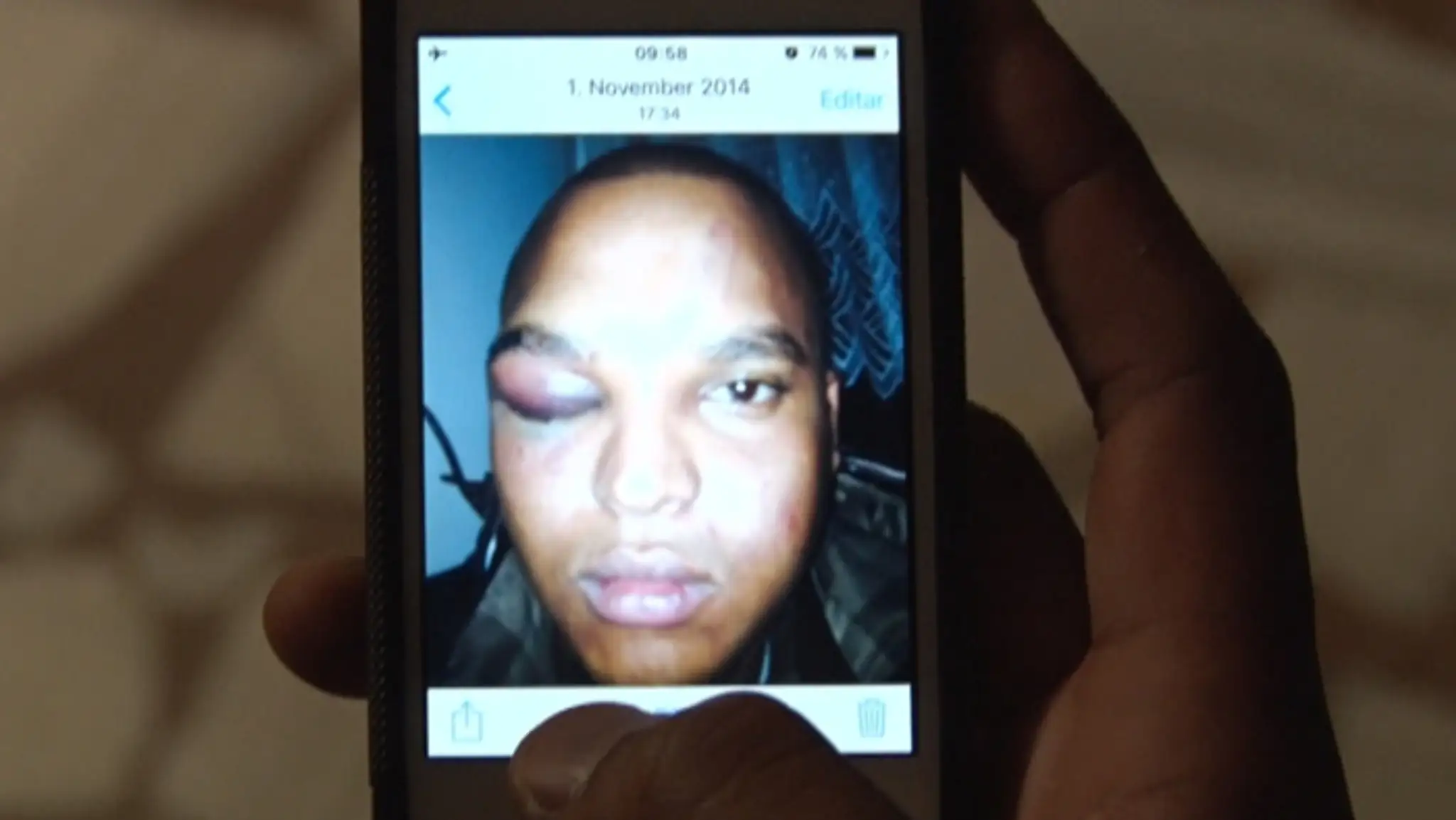 Fotografie zbitého Lennyho Cruza po útoku 1. novembra 2014. 
