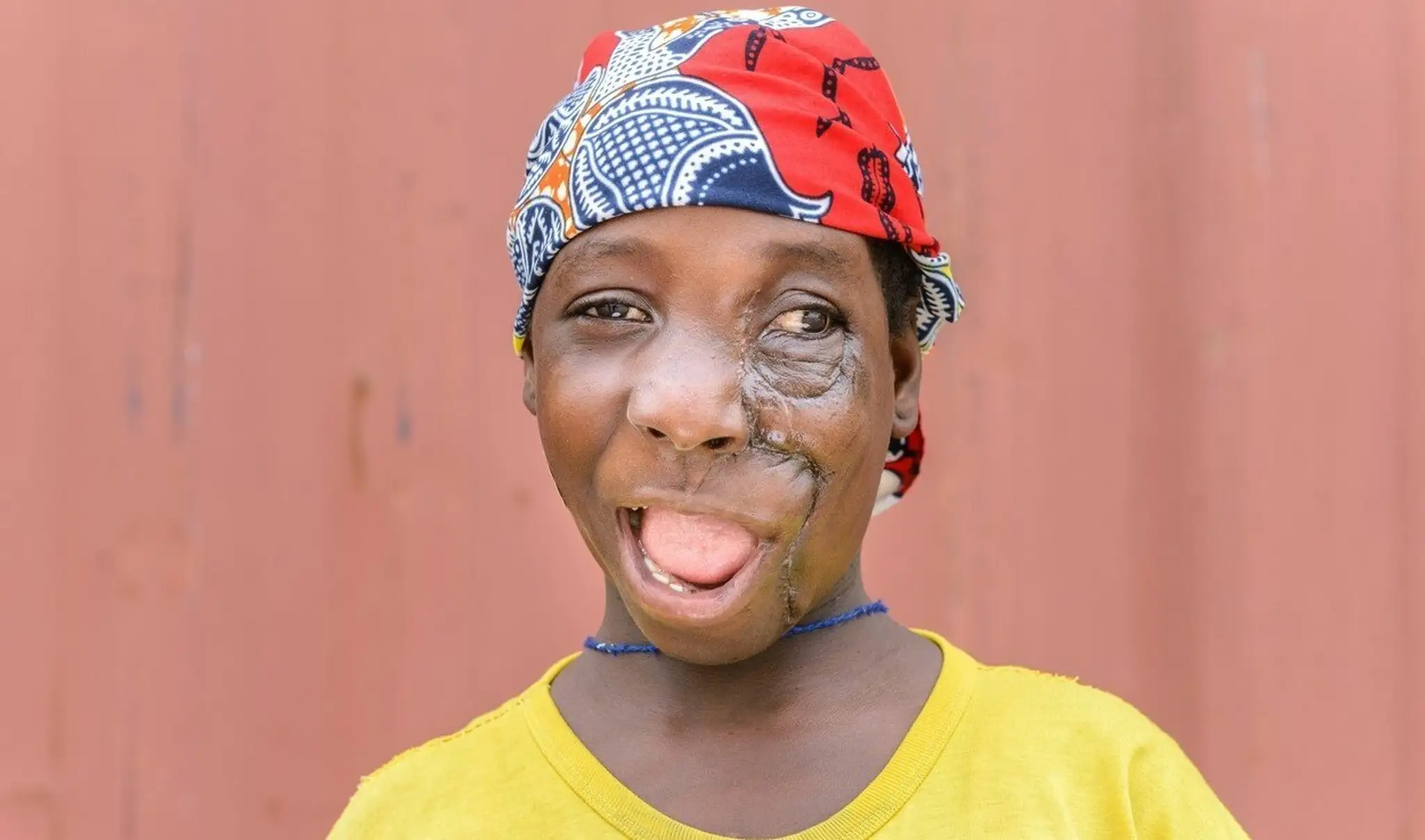 Kaltoumi z Afriky mala na tvári obrosvký nádor
