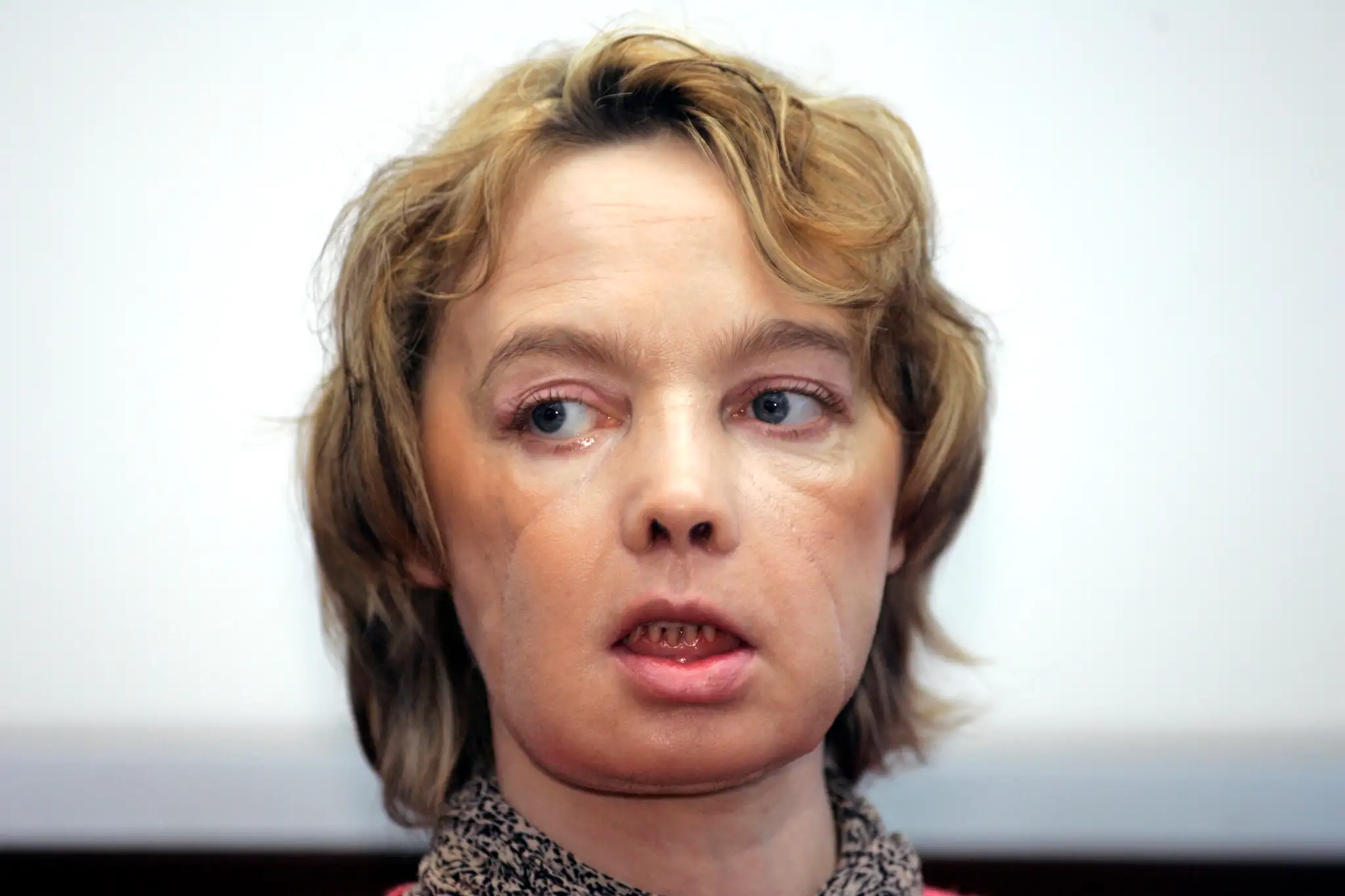 Isabelle Dinoire